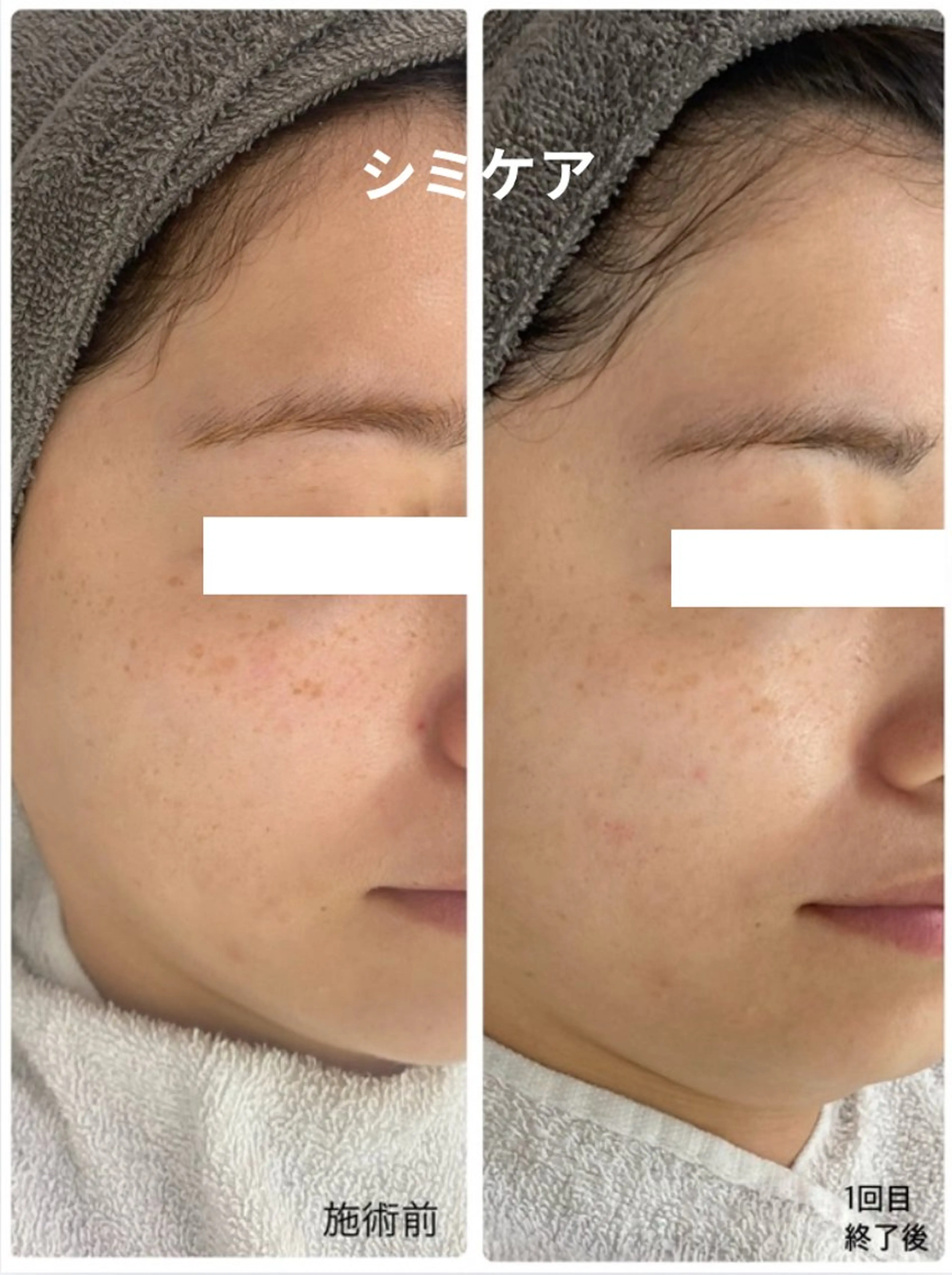 【紫外線によるシミ】シミケアお試し20分ケア放題 通常9,980円の写真