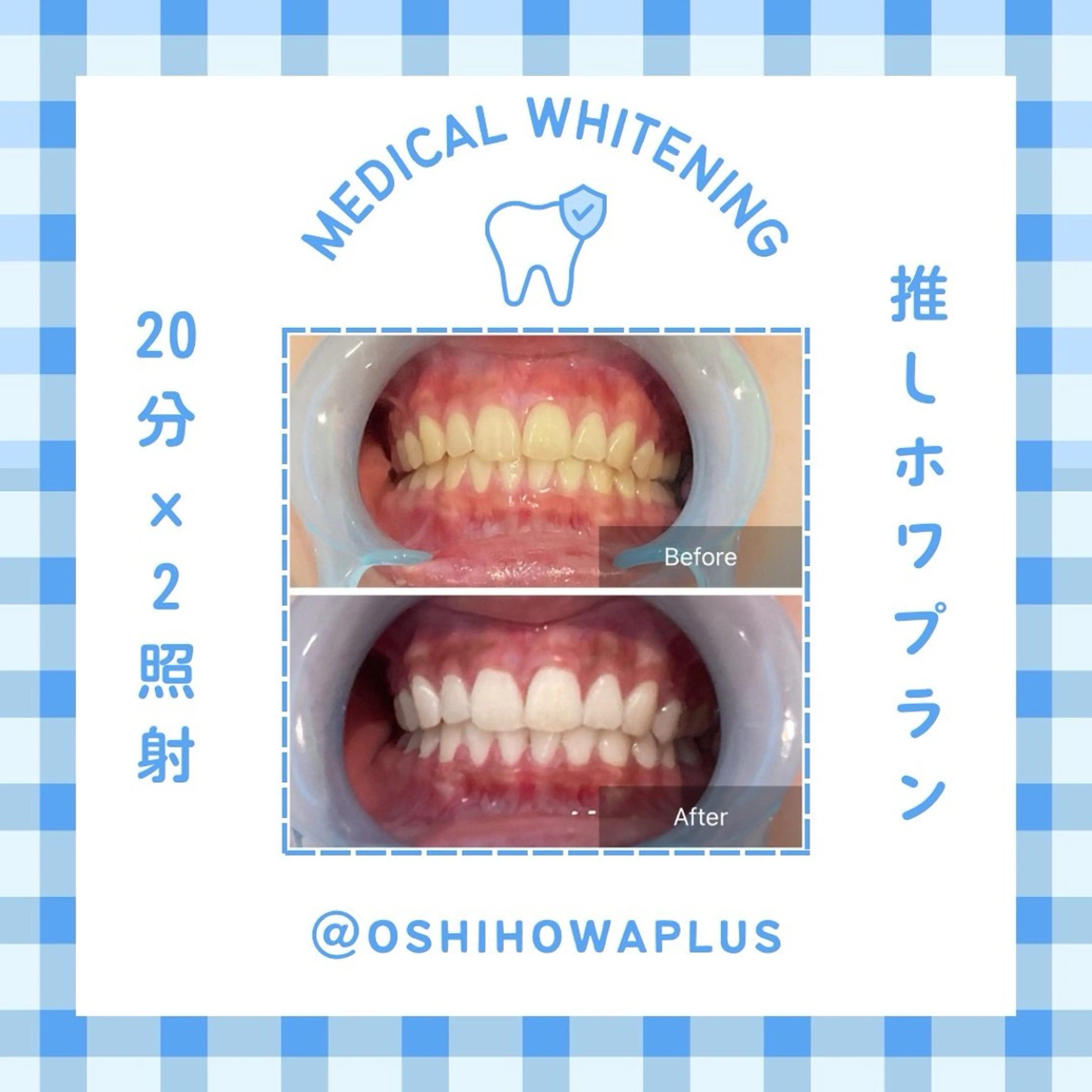 オフィスホワイトニング 回数券 14日分(20分×2回照射 28回) 🍀【1日あたり約￥5,800！】の写真