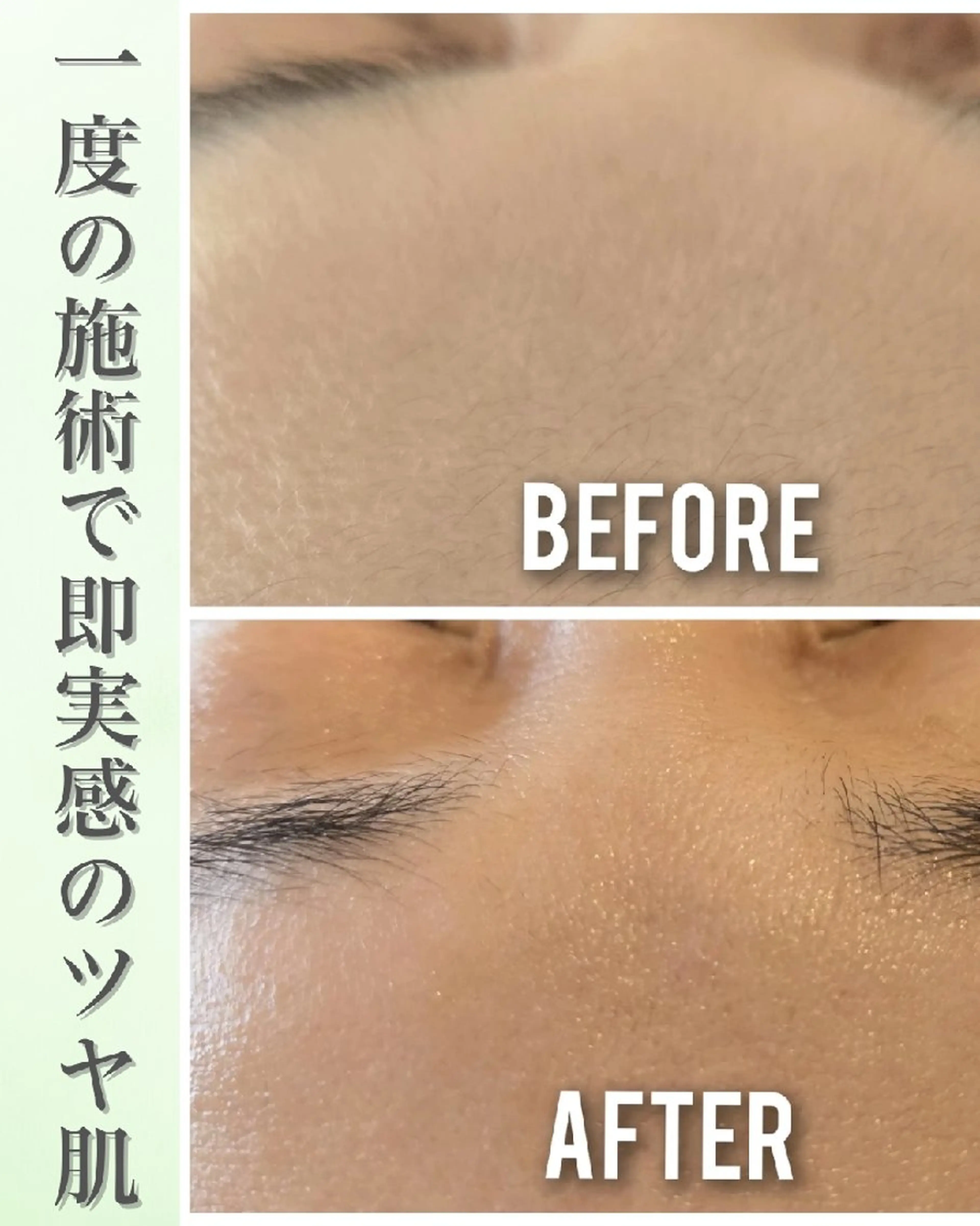 お試しフェイシャルwax   おでこ〜目まわりの写真