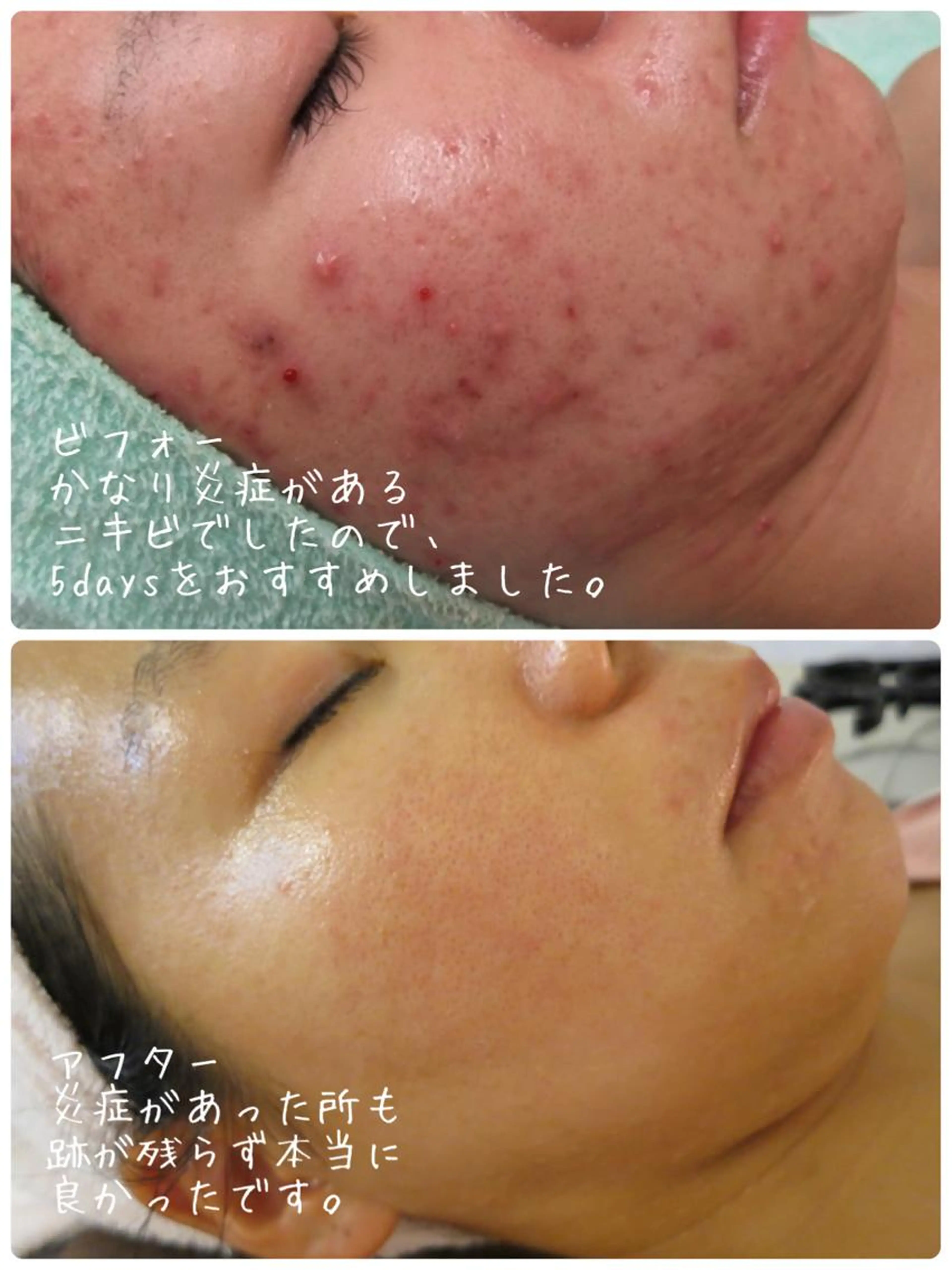 グリーンピール5days最も結果の出るコースです♪本気で綺麗になりたい方・酒さで困ってる方・男性にも人気です。の写真