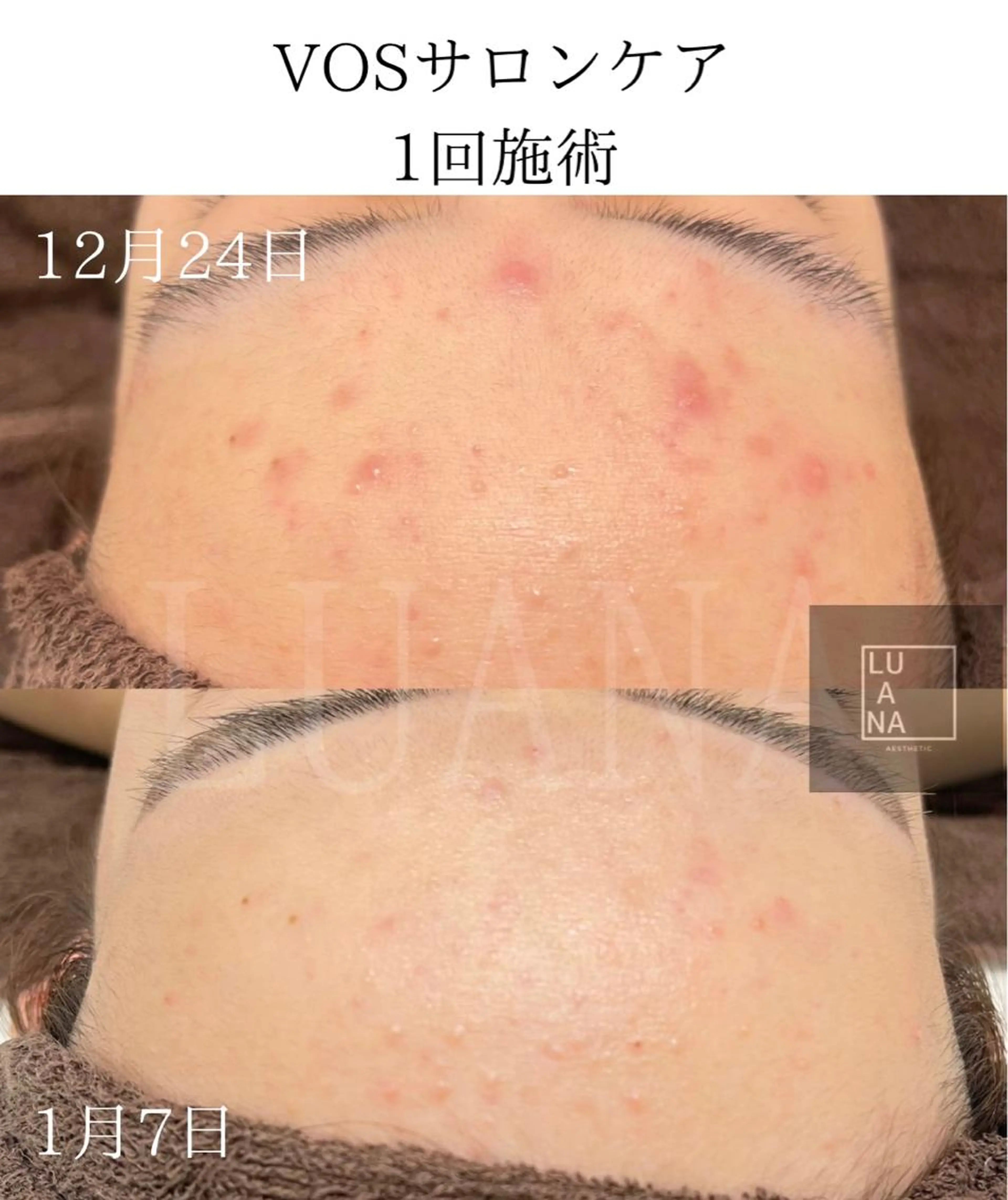 ニキビやニキビ跡・毛穴の悩みに！リピート率90％のHARIピーリング！ホームケア商品付きの写真