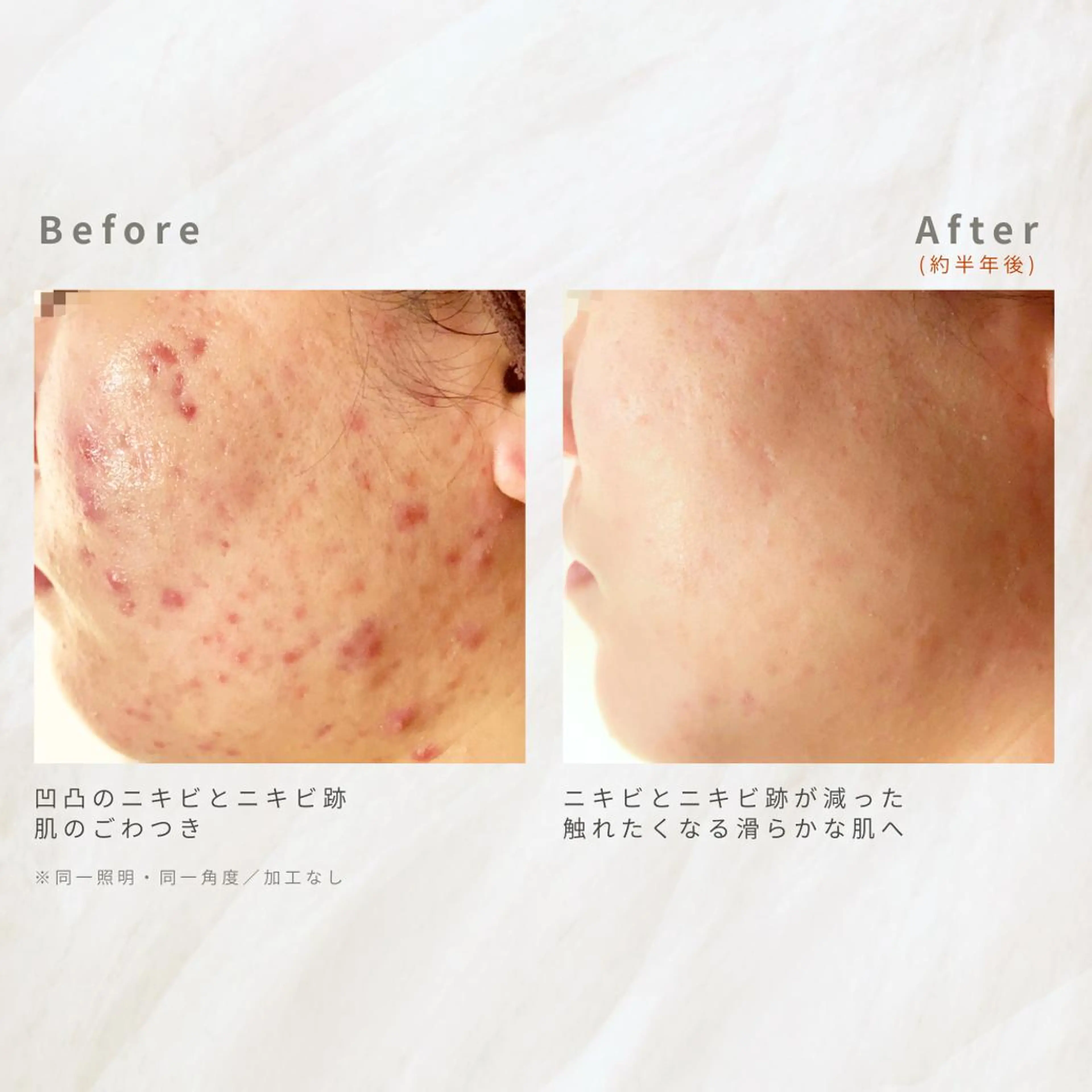 繰り返すニキビを改善 ✨つくば肌質改善専門のエステ・リラクイメージ