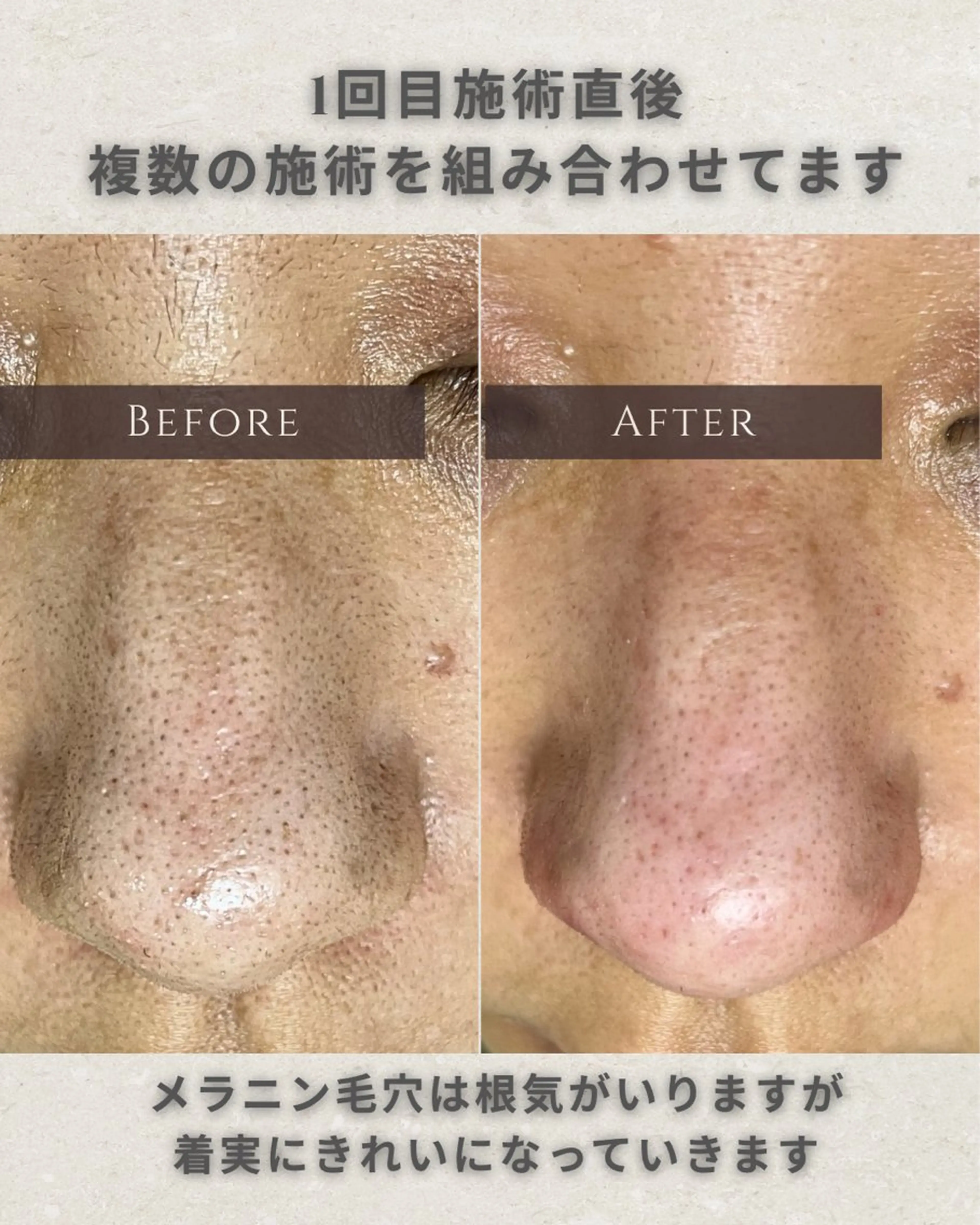 エステ シミ毛穴|眉Wax THE  flowのエステ・リラクイメージ