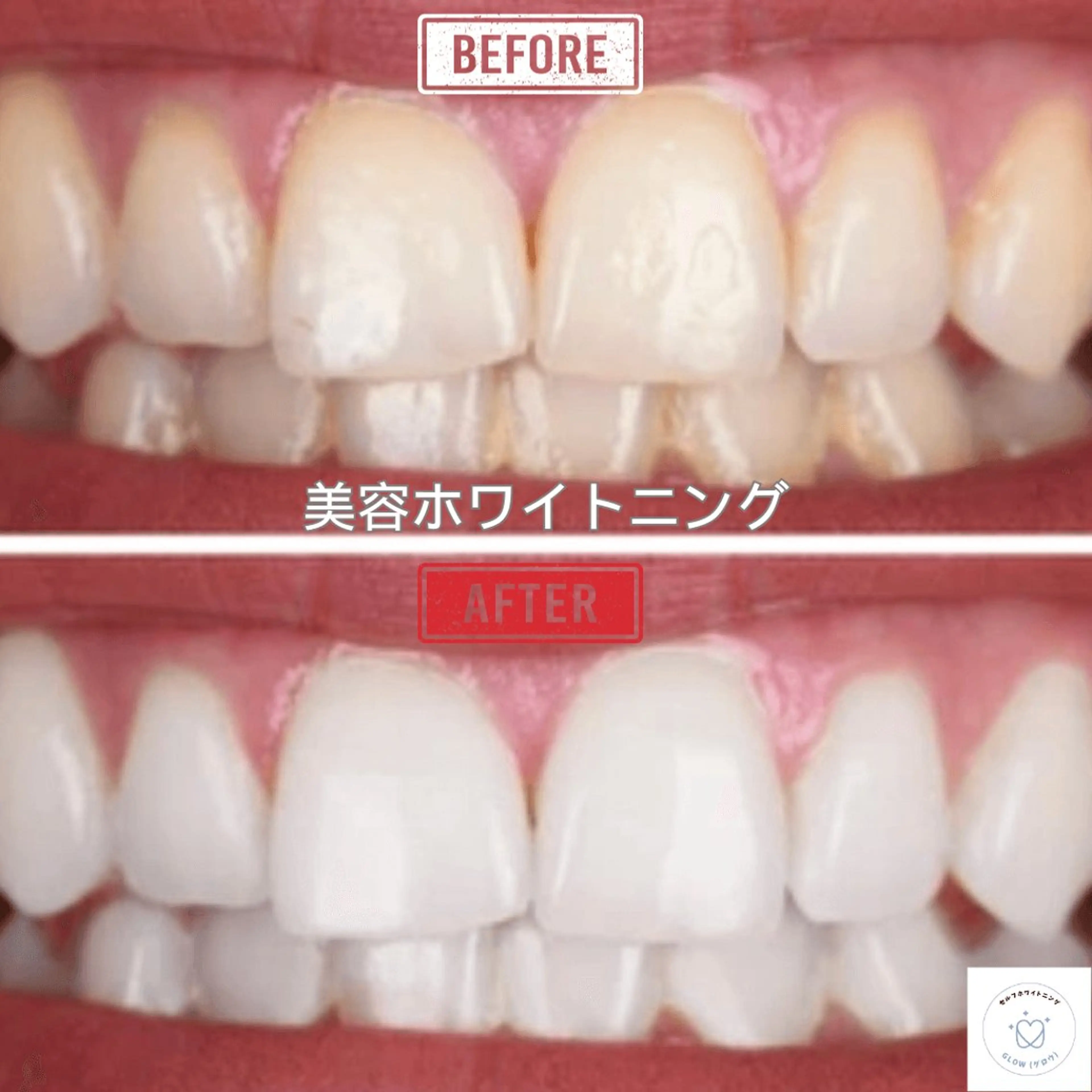 歯のセルフホワイトニング専門店GLOW（グロウ）所属・東区香椎歯のセルフホ ワイトニングGLOWのその他イメージ