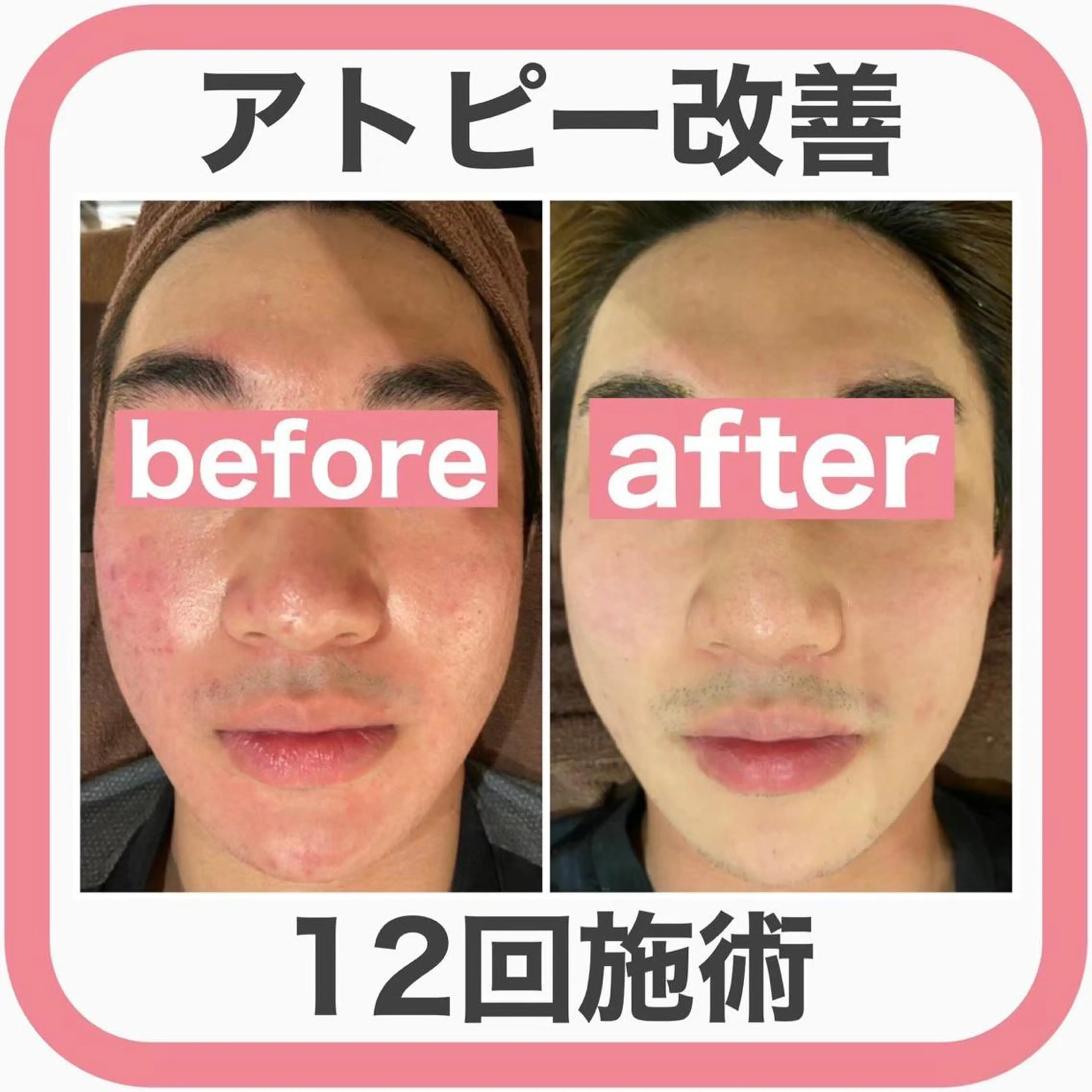 ニキビ跡改善専門🔥 医療にはできない改善のエステ・リラクイメージ