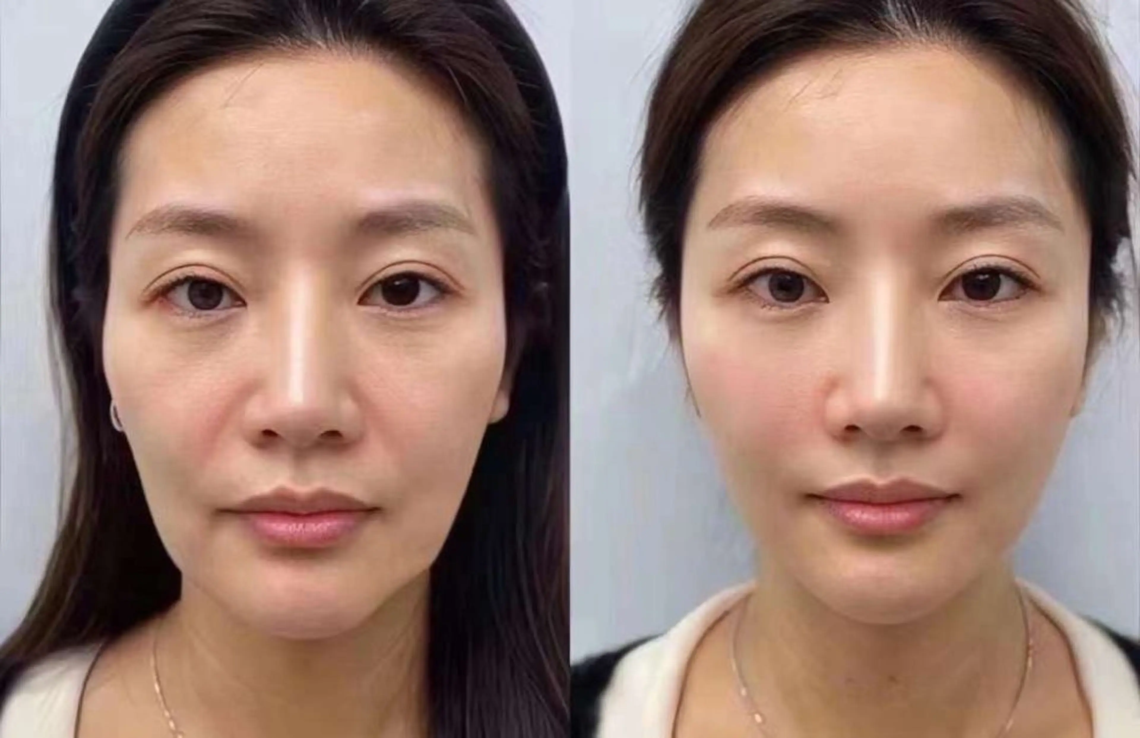 ネイル ブライダルネイル ホワイト エステ aliaハイフ&水光ジェットサロン所属・aliaハーブ水光店 エステティシャン募集のエステ・リラクイメージ