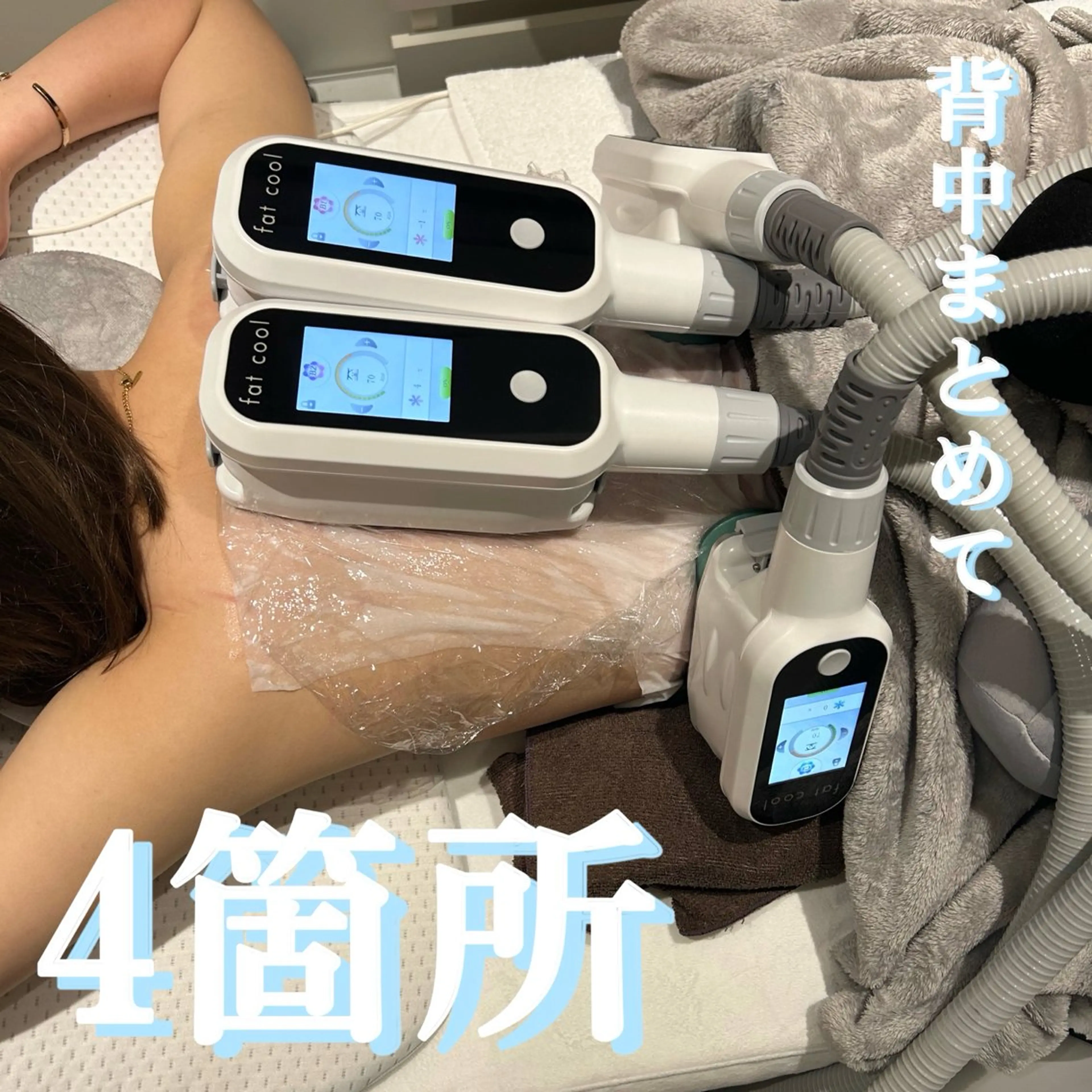 脂肪痩身〈背中〉初回体験3~4カップの写真