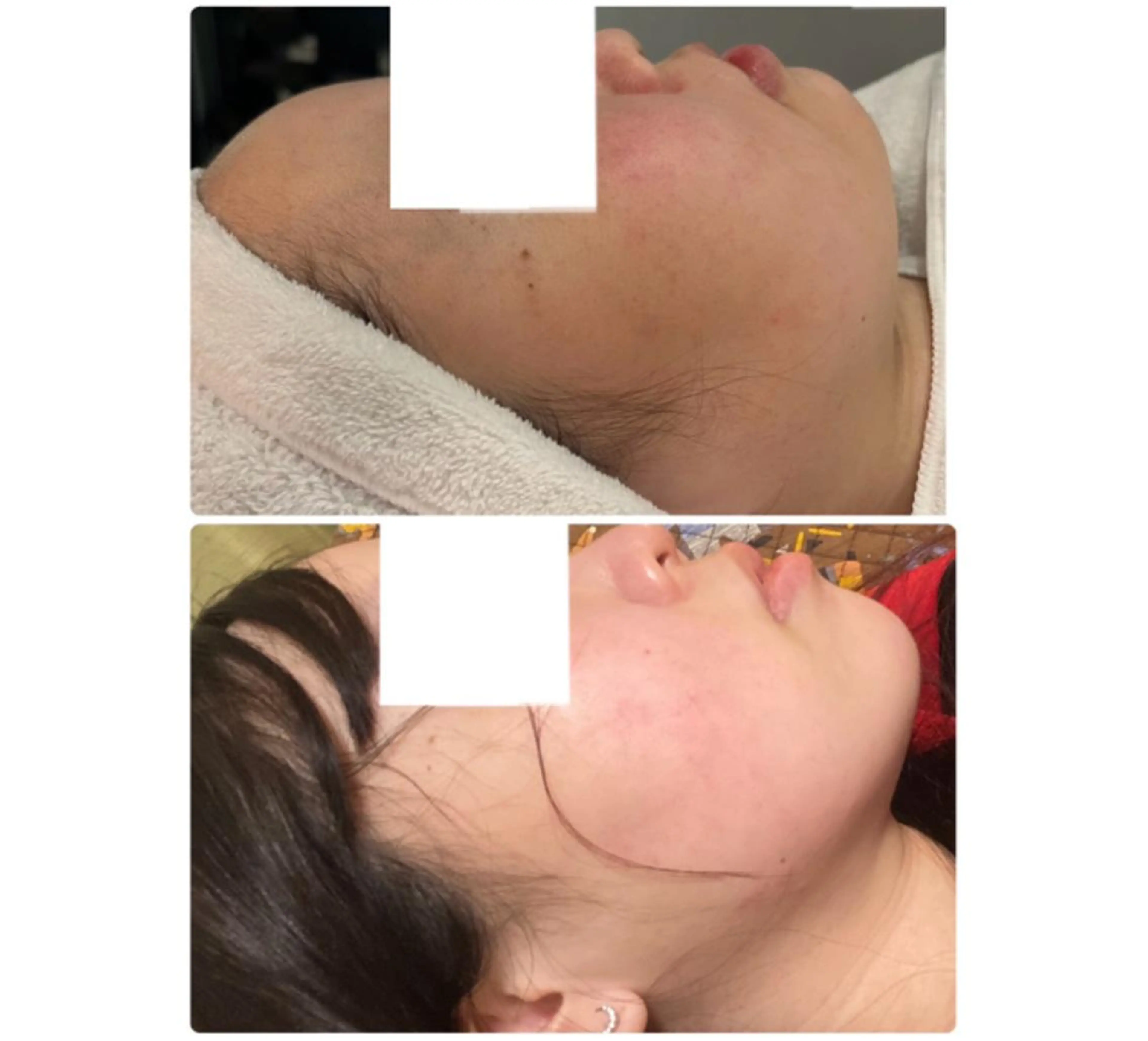 【二重アゴ＆フェイスライン集中】リバウンド❌気になる脂肪を🔥レモンボトル３cc🍋💉安心安全オーガニック🌳の写真