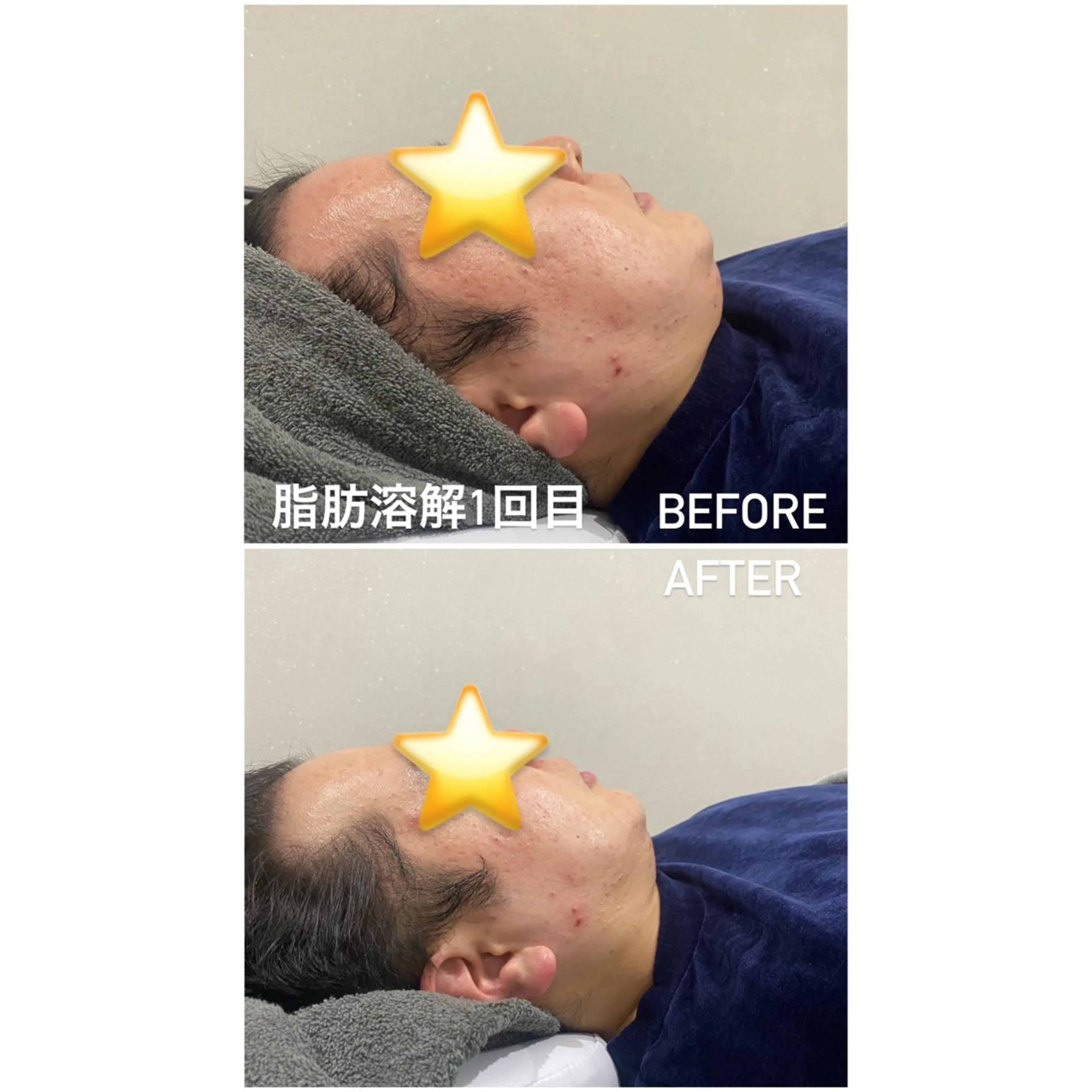 【男女】脂肪除去顔（5ml）の写真