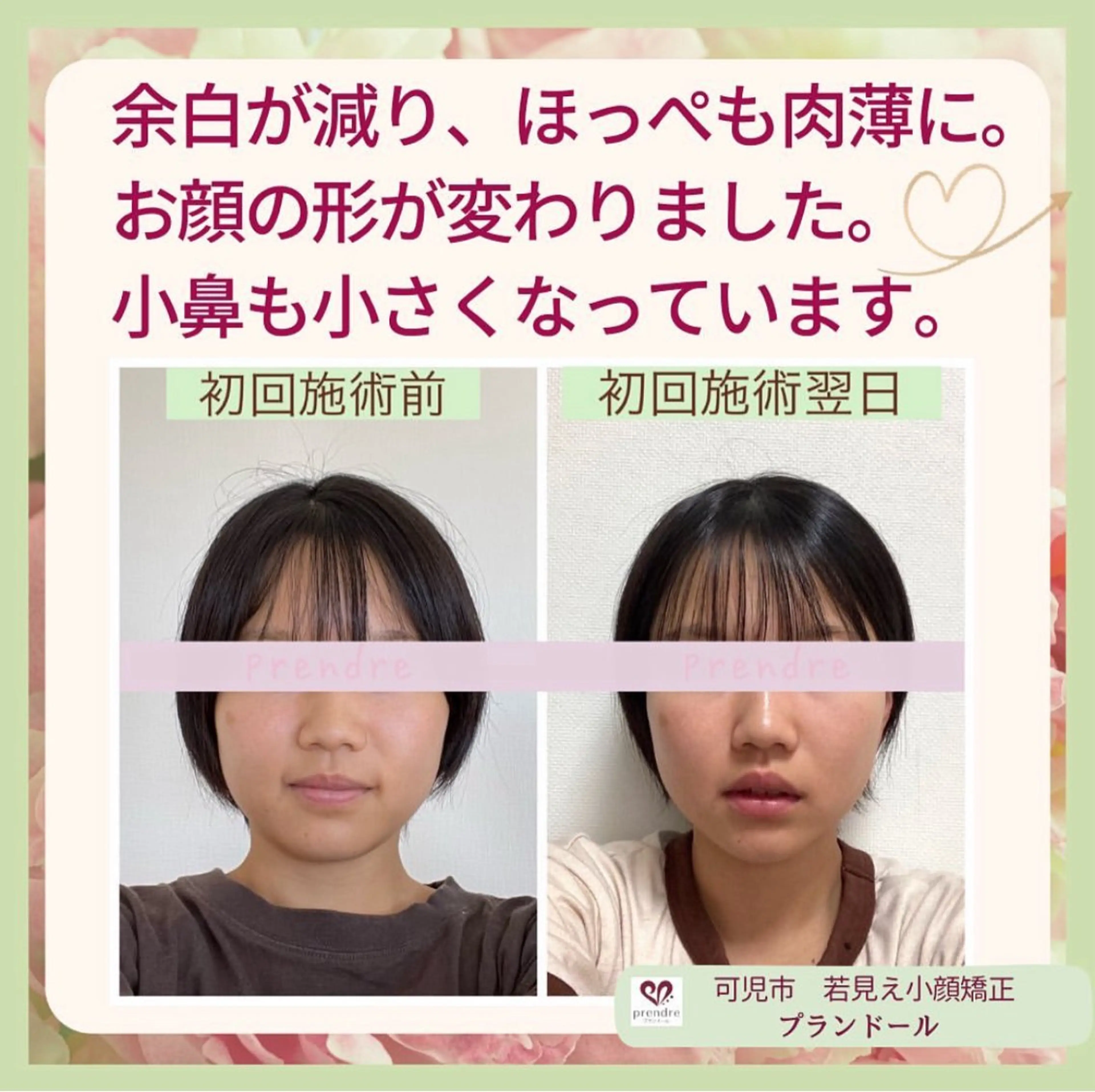 憧れV字ラインへ💎｢あご下をスッキリ✨️小顔矯正マッサージ」💆‍♀️初回🔰の写真