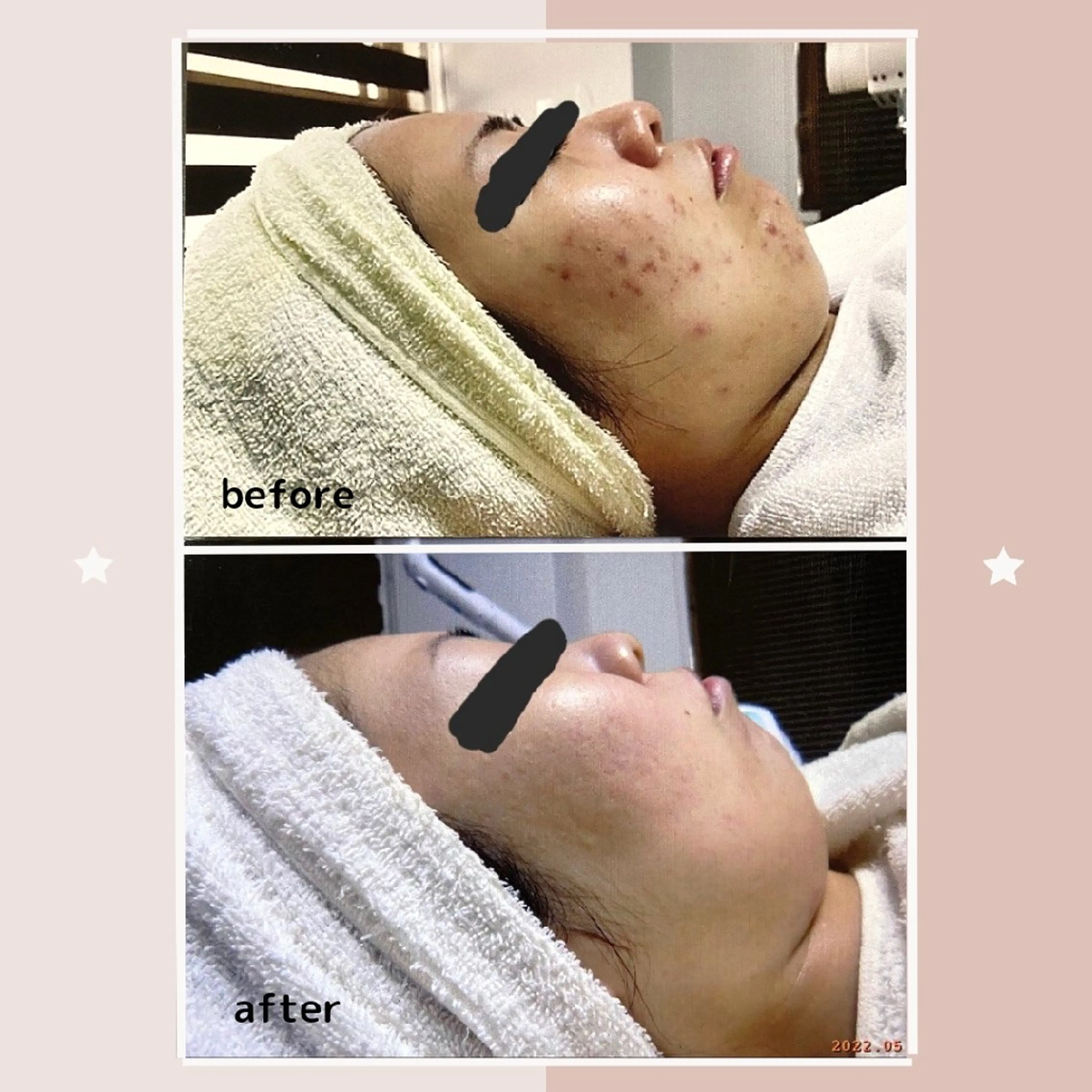 ニキビケア＆ニキビ跡 レゾン京橋店　のエステ・リラクイメージ