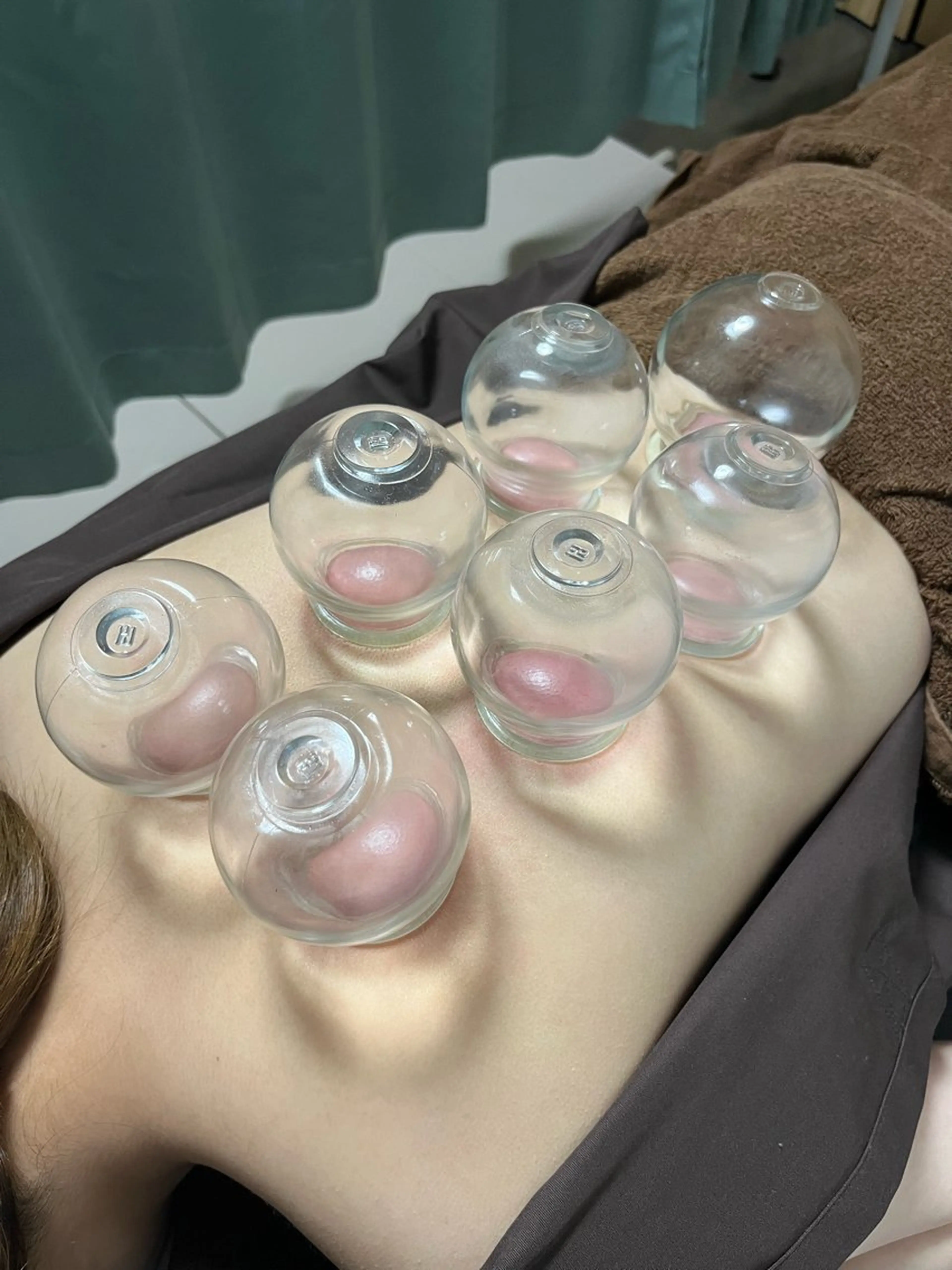 【1/12まで3名さま限定🌷】美容鍼+足リンパマッサージor背中カッピングの写真