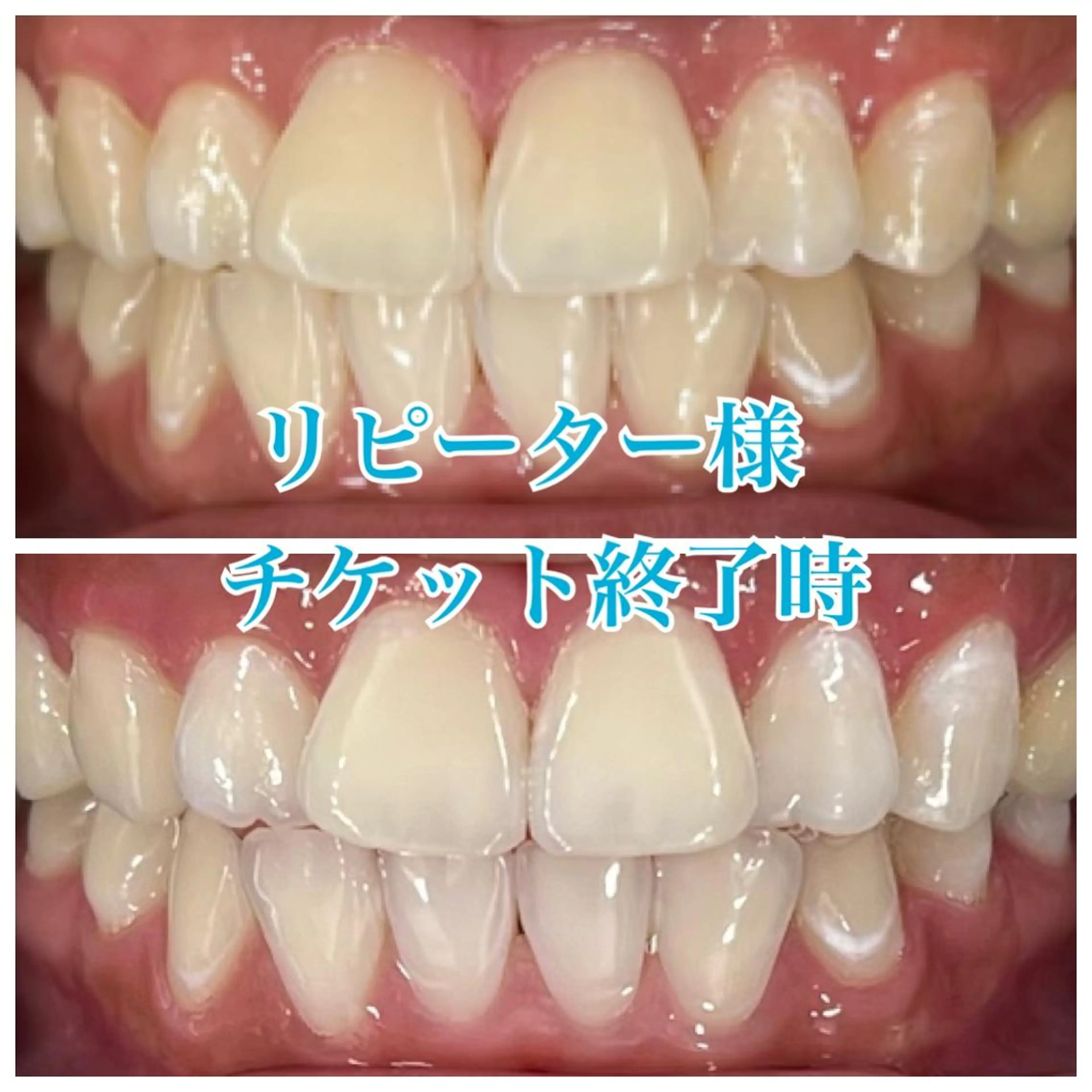 １カ月通い放題✋ホワイトニング1回20分💛早く白くなりたい方はぜひ😋の写真