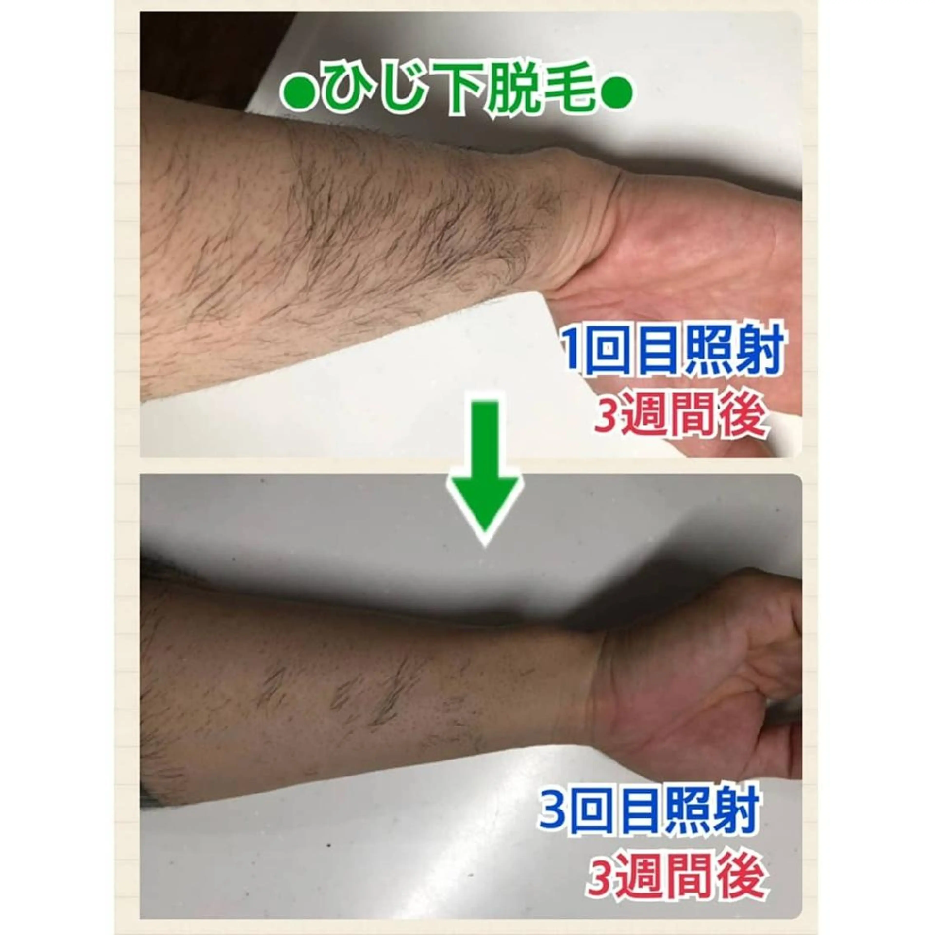 メンズ キッズ 脱毛 メンズ脱毛サロンBiSTA所属・BiSTA ヒロのエステ・リラクイメージ