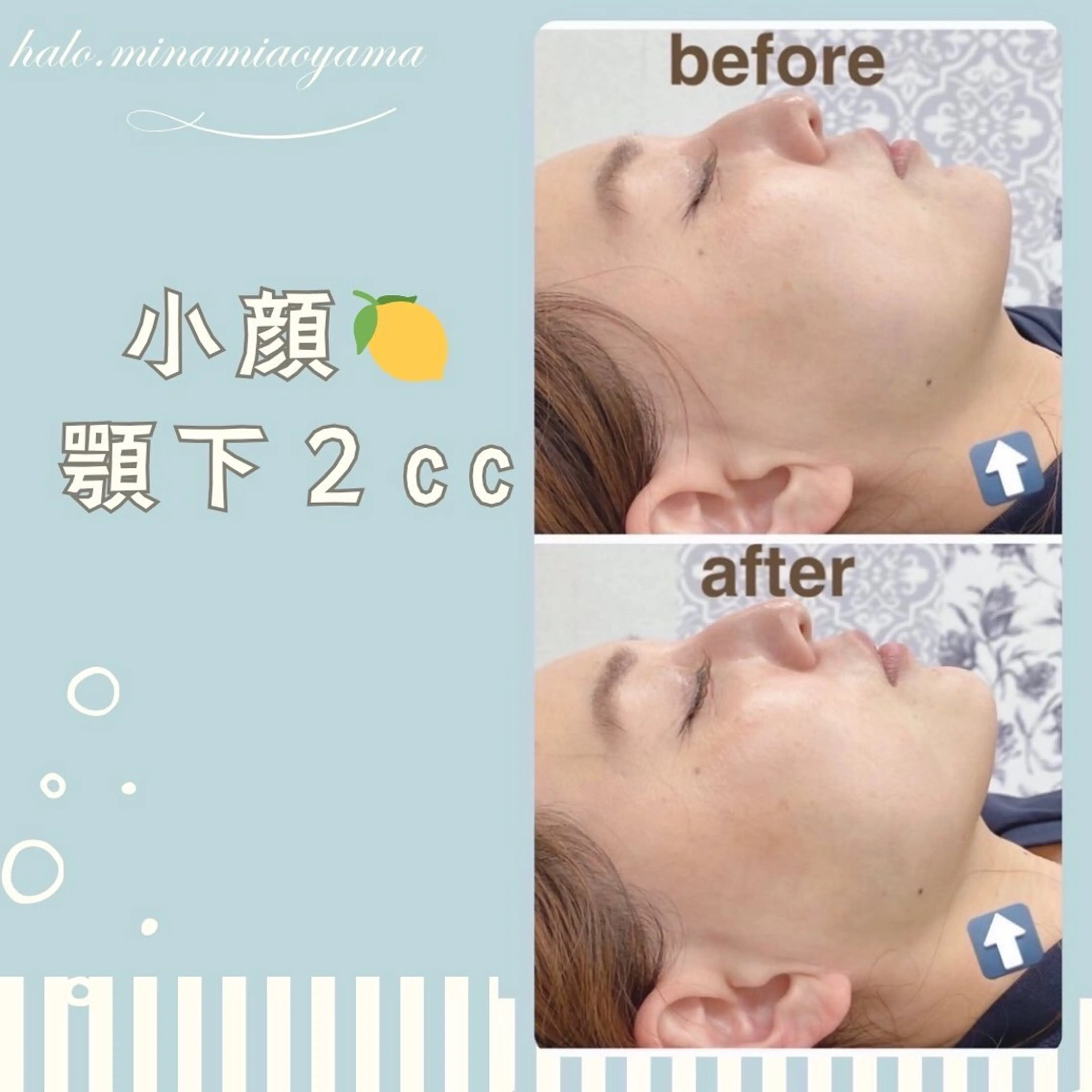 【即小顔】６０分🍋レモンフェイシャル🍋３ccボトル【頬+顎下】の写真