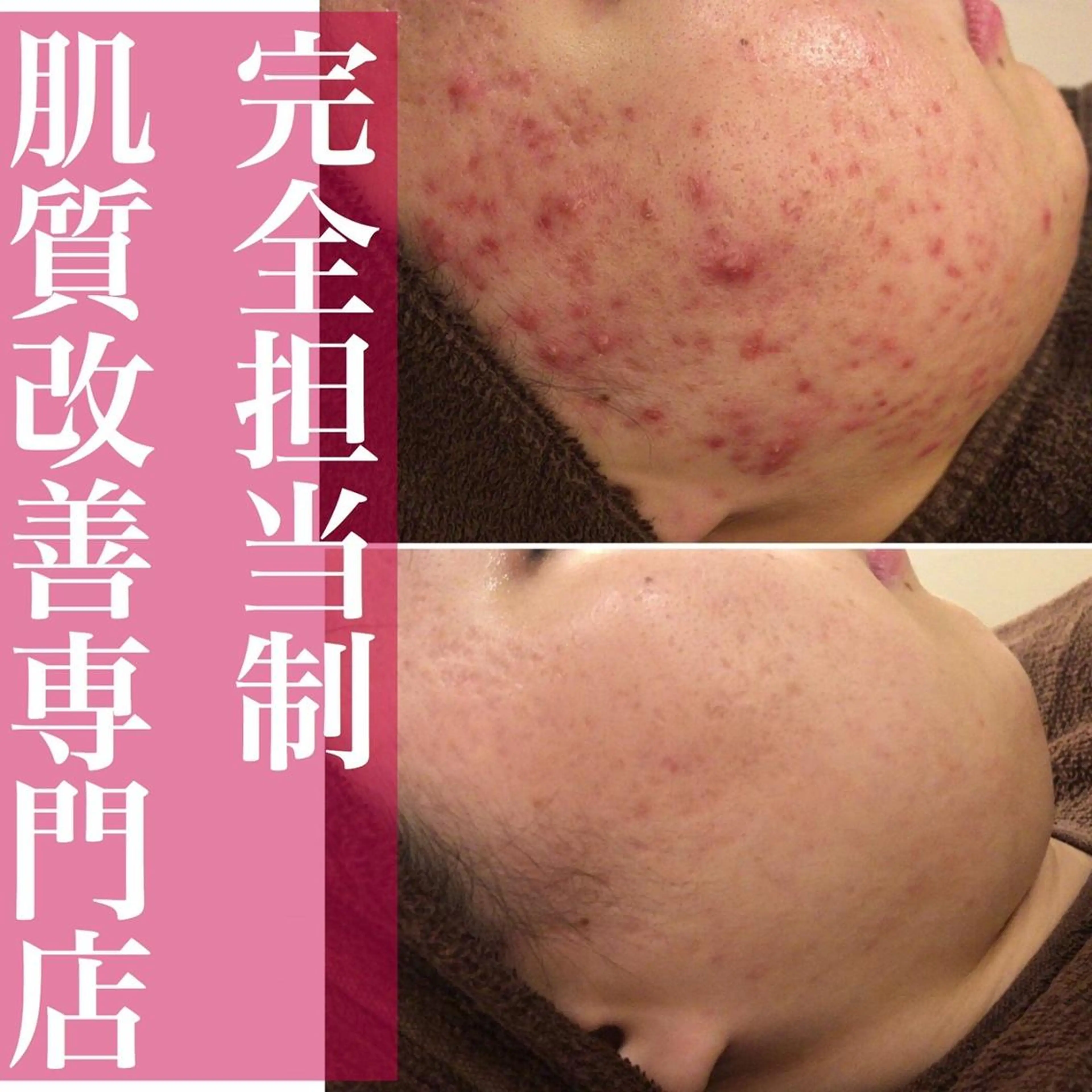 エステ リラク ニキビ特化型エステ 🍓最短で肌質改善のエステ・リラクイメージ