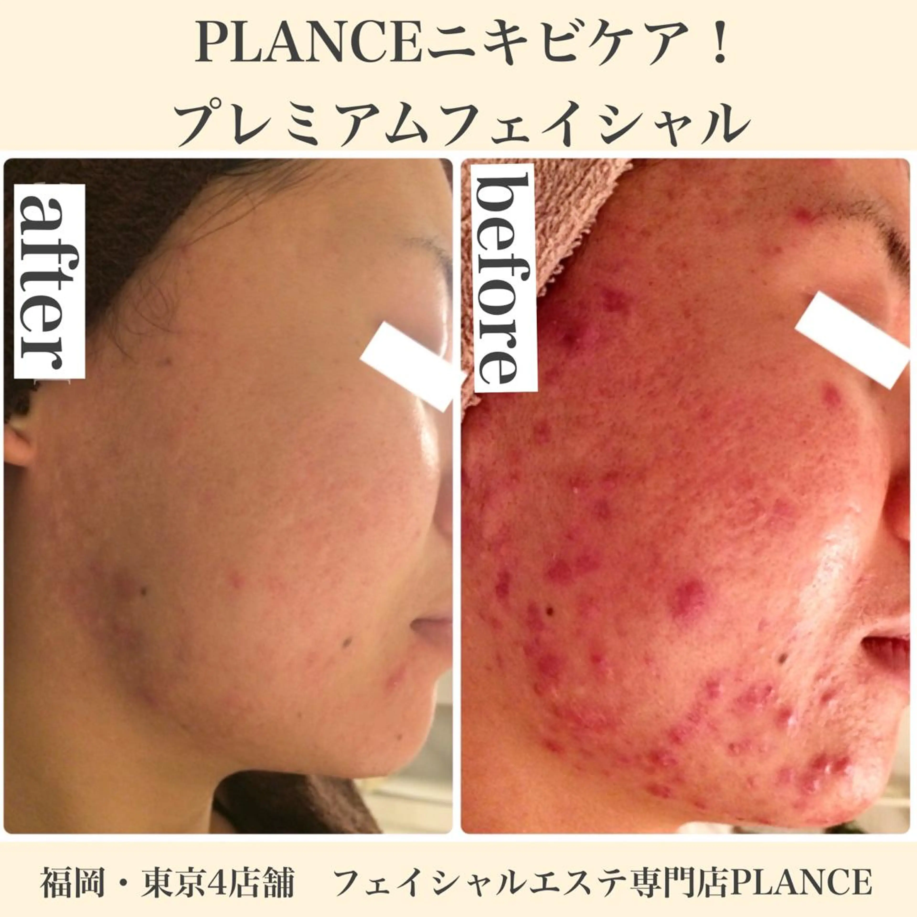 エステ フェイシャル専門 肌質改善/プランスのエステ・リラクイメージ