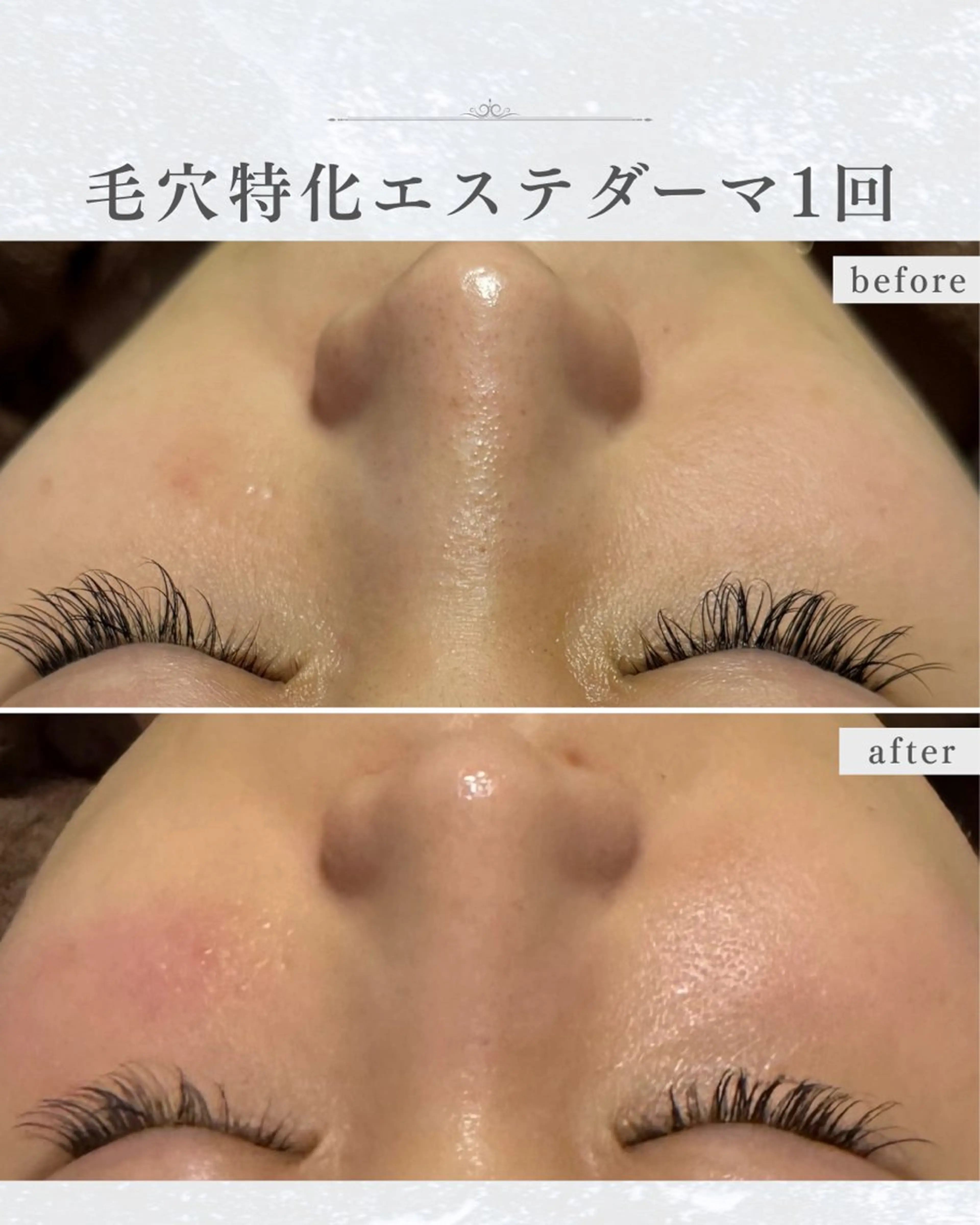 エステ シミ取り×毛穴エステ YUKIのエステ・リラクイメージ