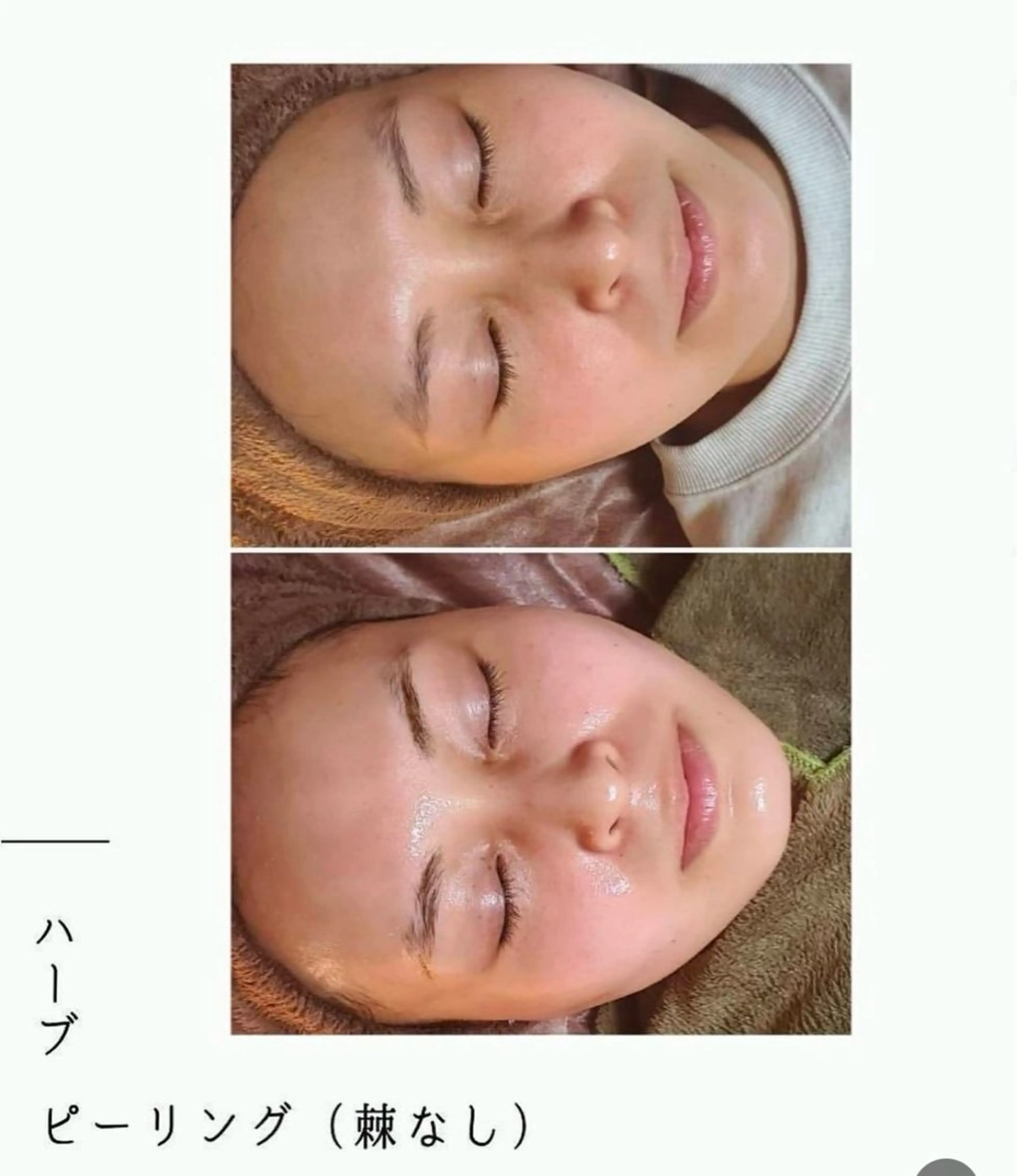 エイジングケアコース♡◎陶器肌🦋ハーブトリートメント🌿にきび・シミ・肌荒れにも🌿効果大◎の写真