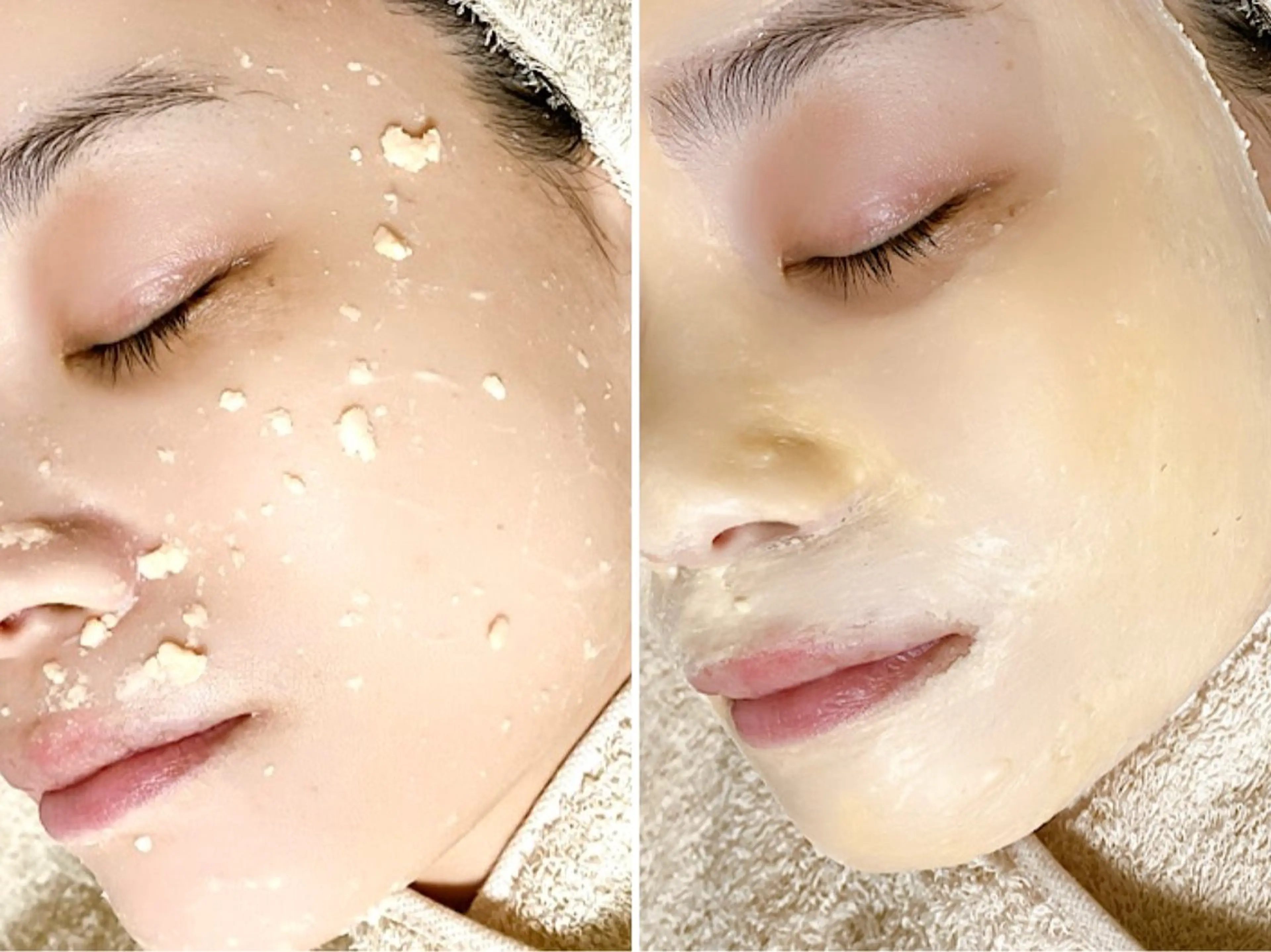 【結果出し🌈赤み・ニキビケア】イオンピーリング/温熱石膏パック/マッサージ(施術時間90分)の写真