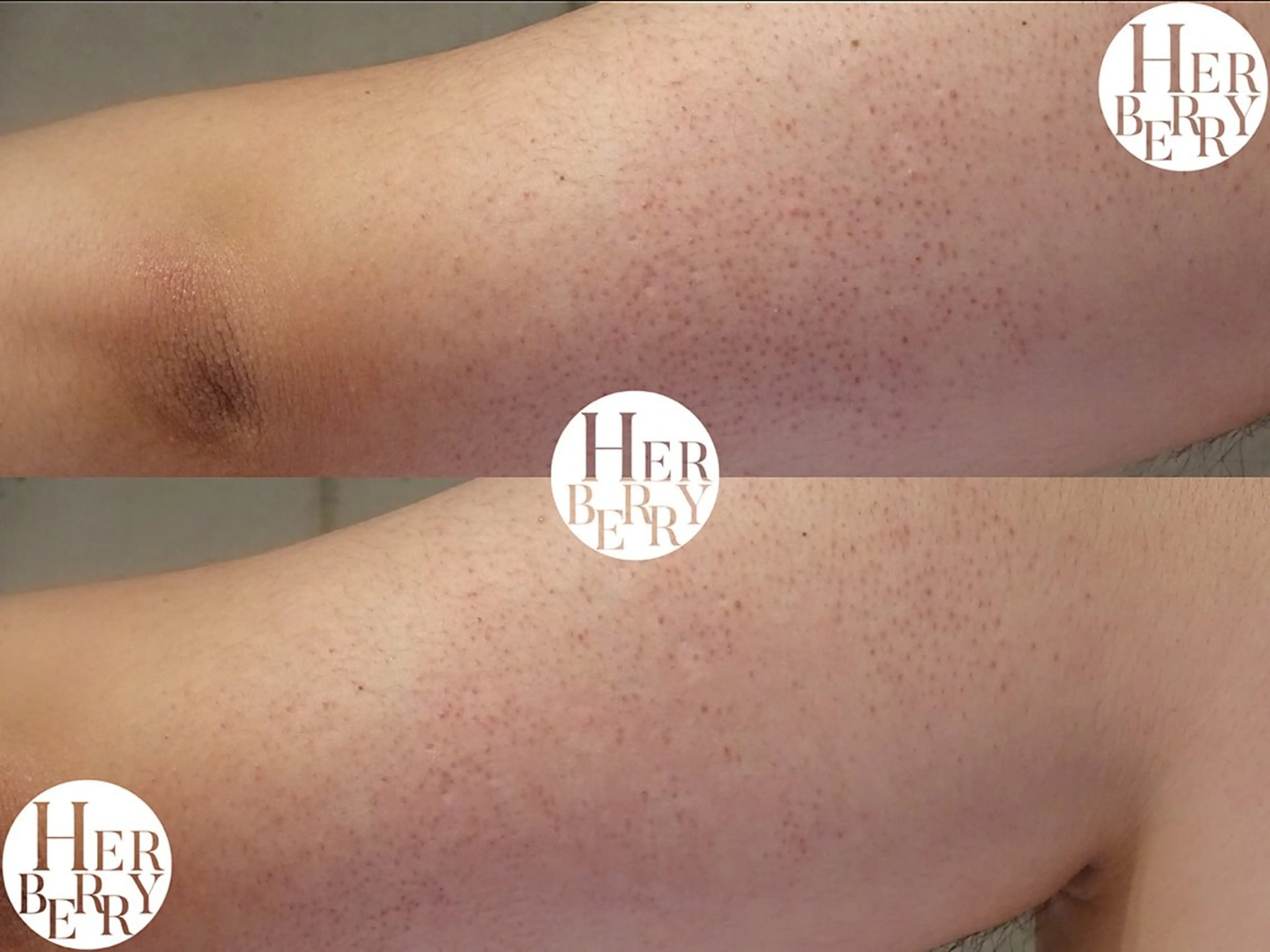 【FCR】ハーブピーリング2000円券付き★《お尻》黒ずみ等￥22000（剥離あり）の写真