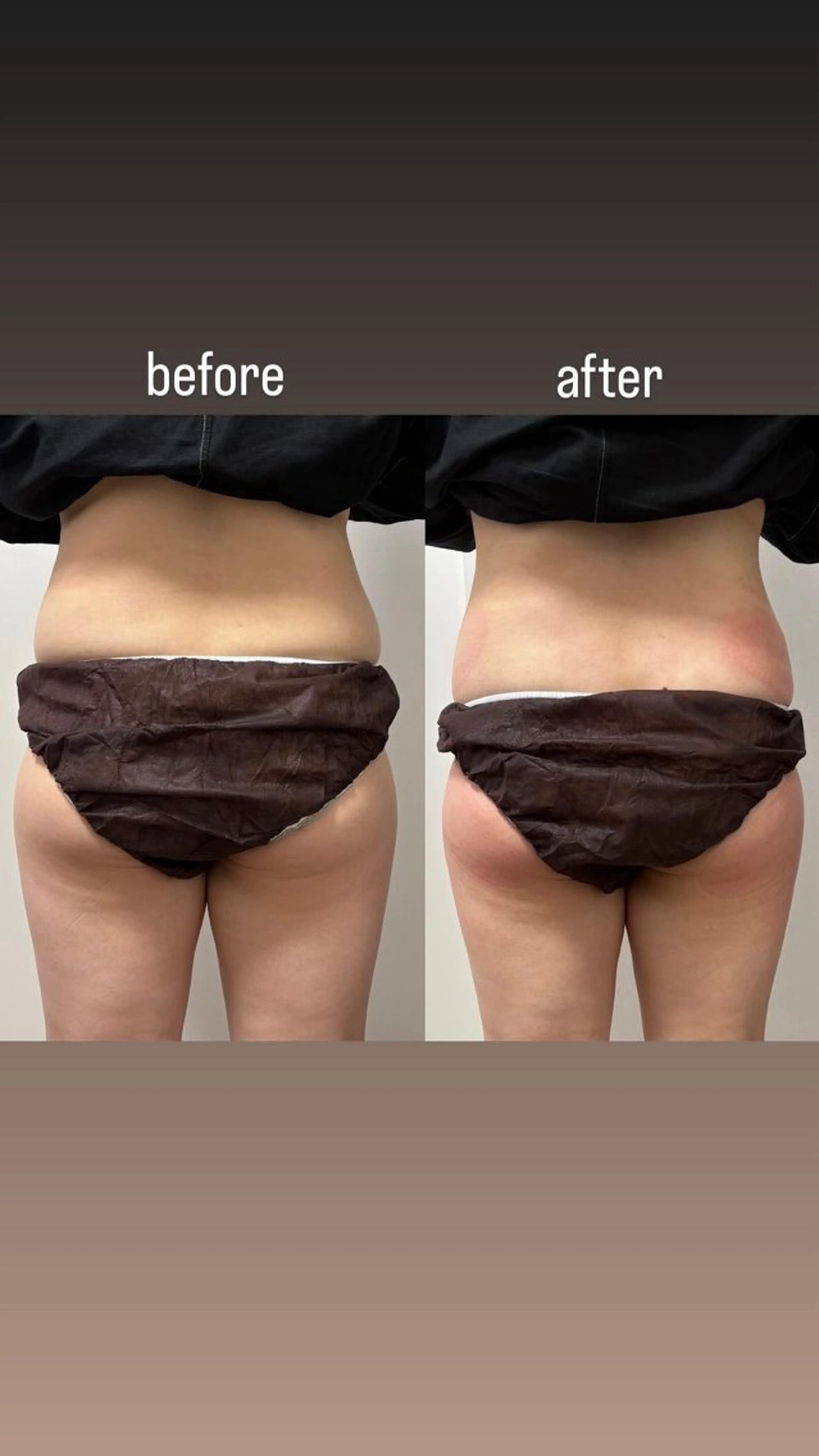 Miiju.所属・Miiju. 石巻市 脂肪冷却  鈴木のエステ・リラクイメージ