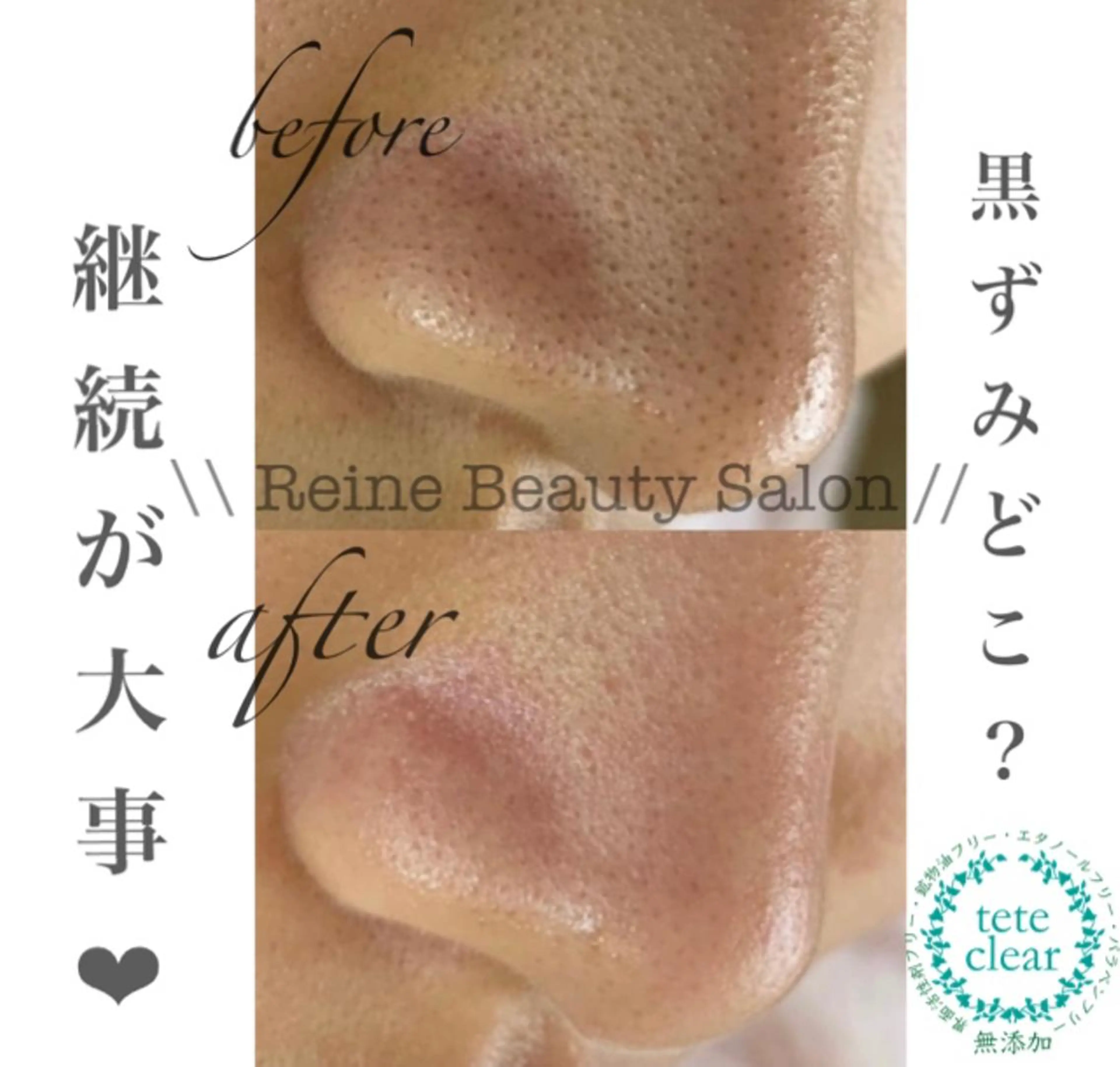 エステ Reine BeautySalon所属・毛穴/シミ肝斑/脱毛 横山梨里のエステ・リラクイメージ