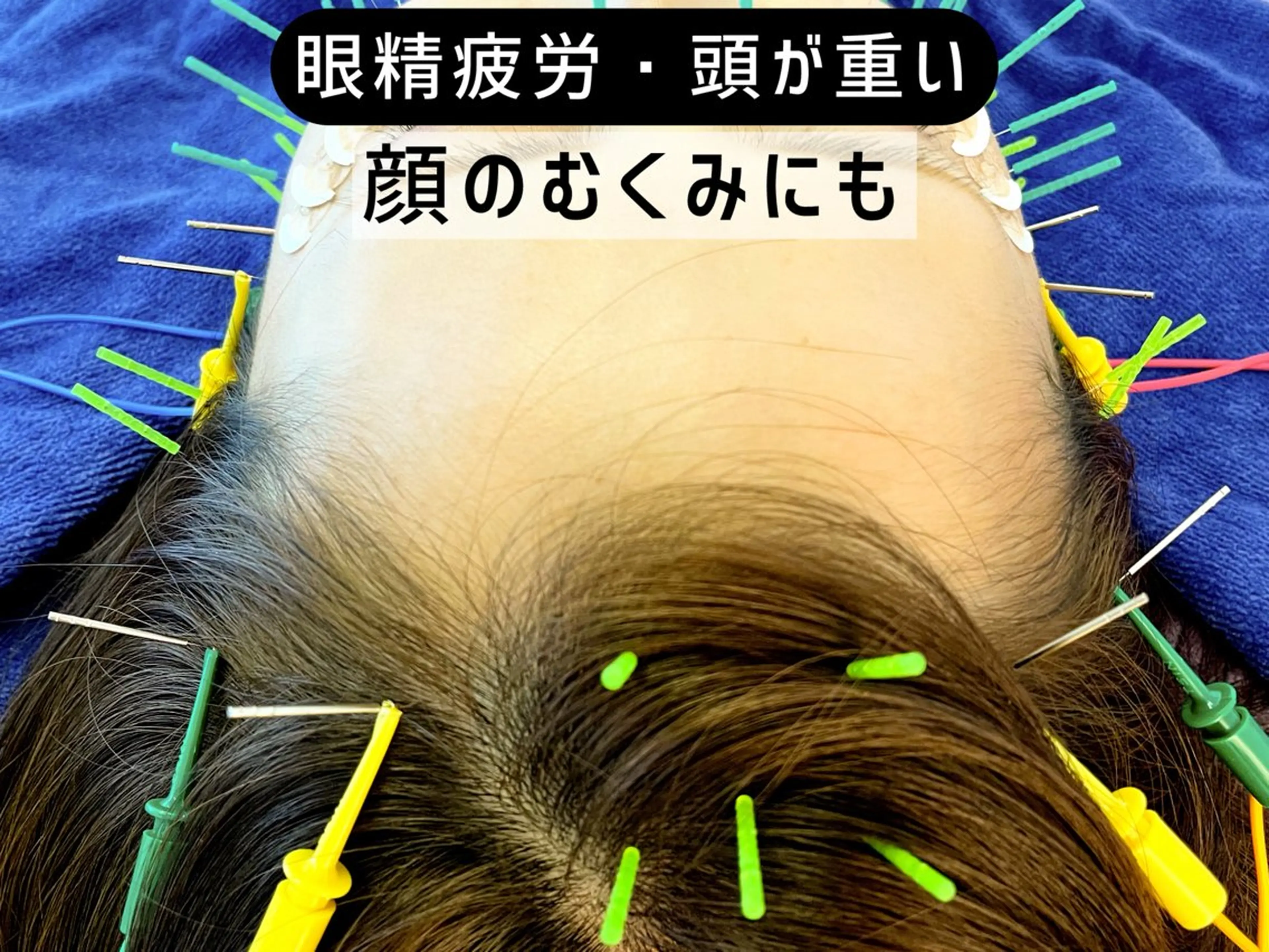 エステ リラク 小顔美容鍼専門サロン 渋谷YZのエステ・リラクイメージ
