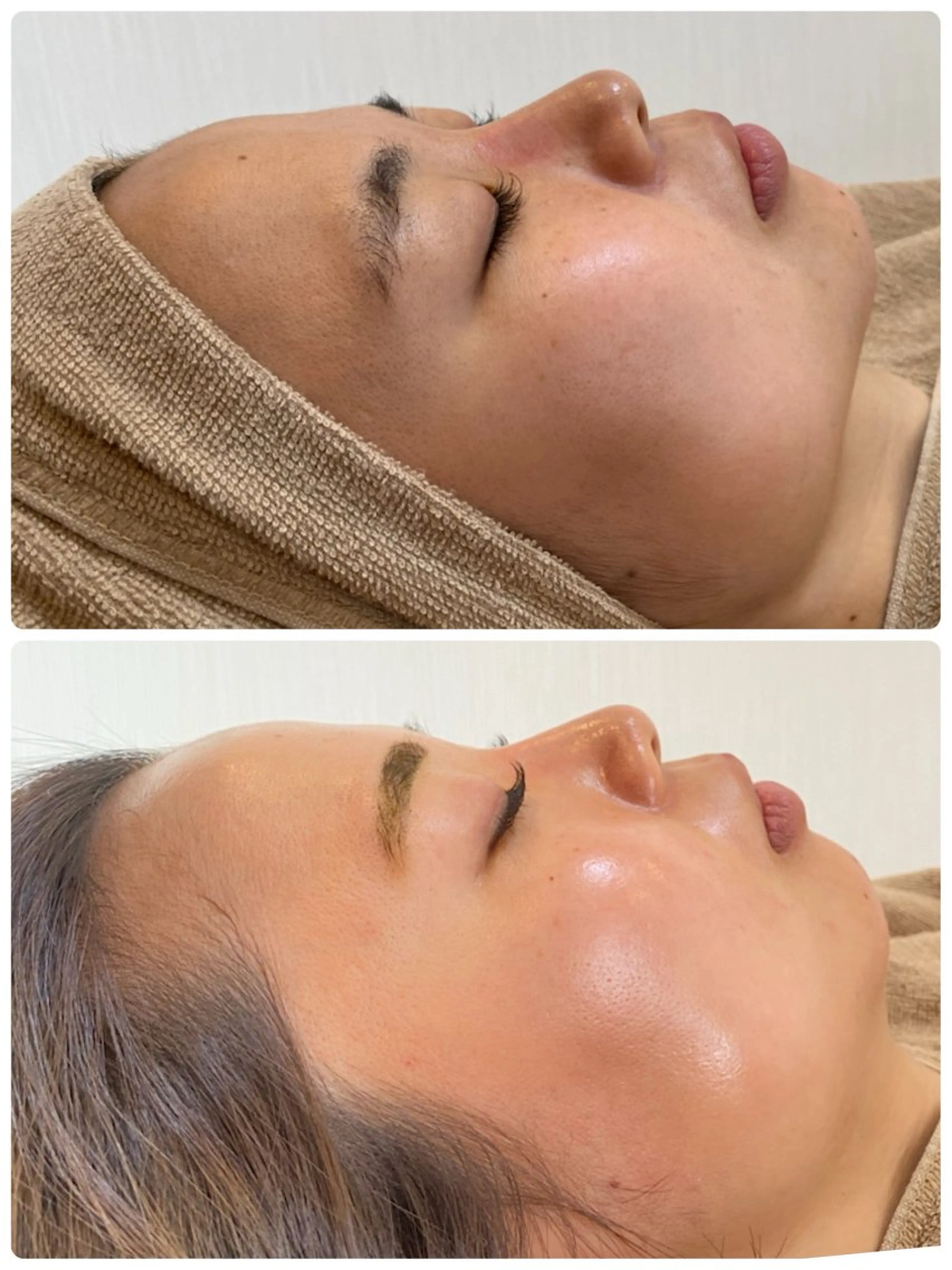 溶ける糸リフト＆塗るボトックスの写真