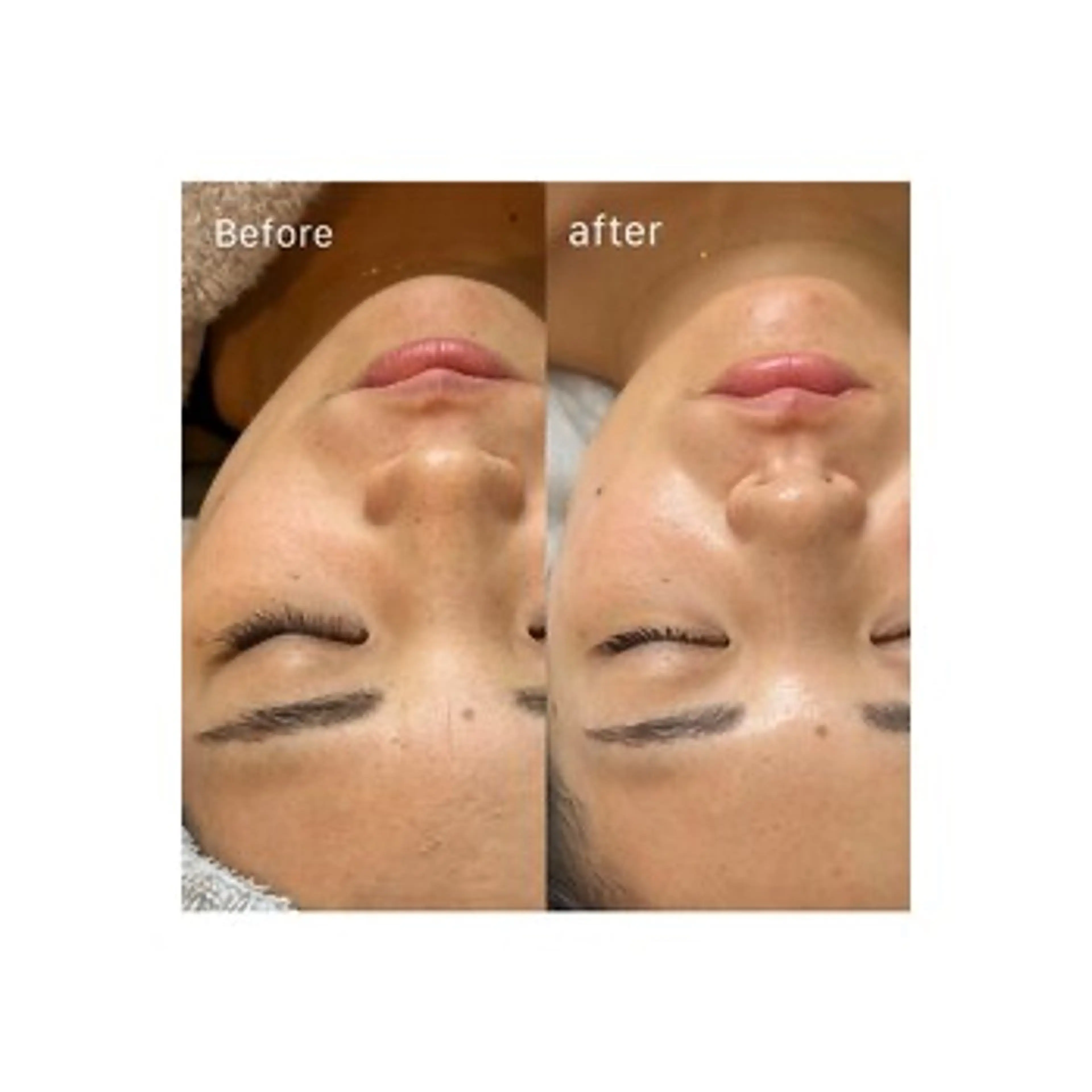 光フォト+肌質別パック ¥5,000の写真