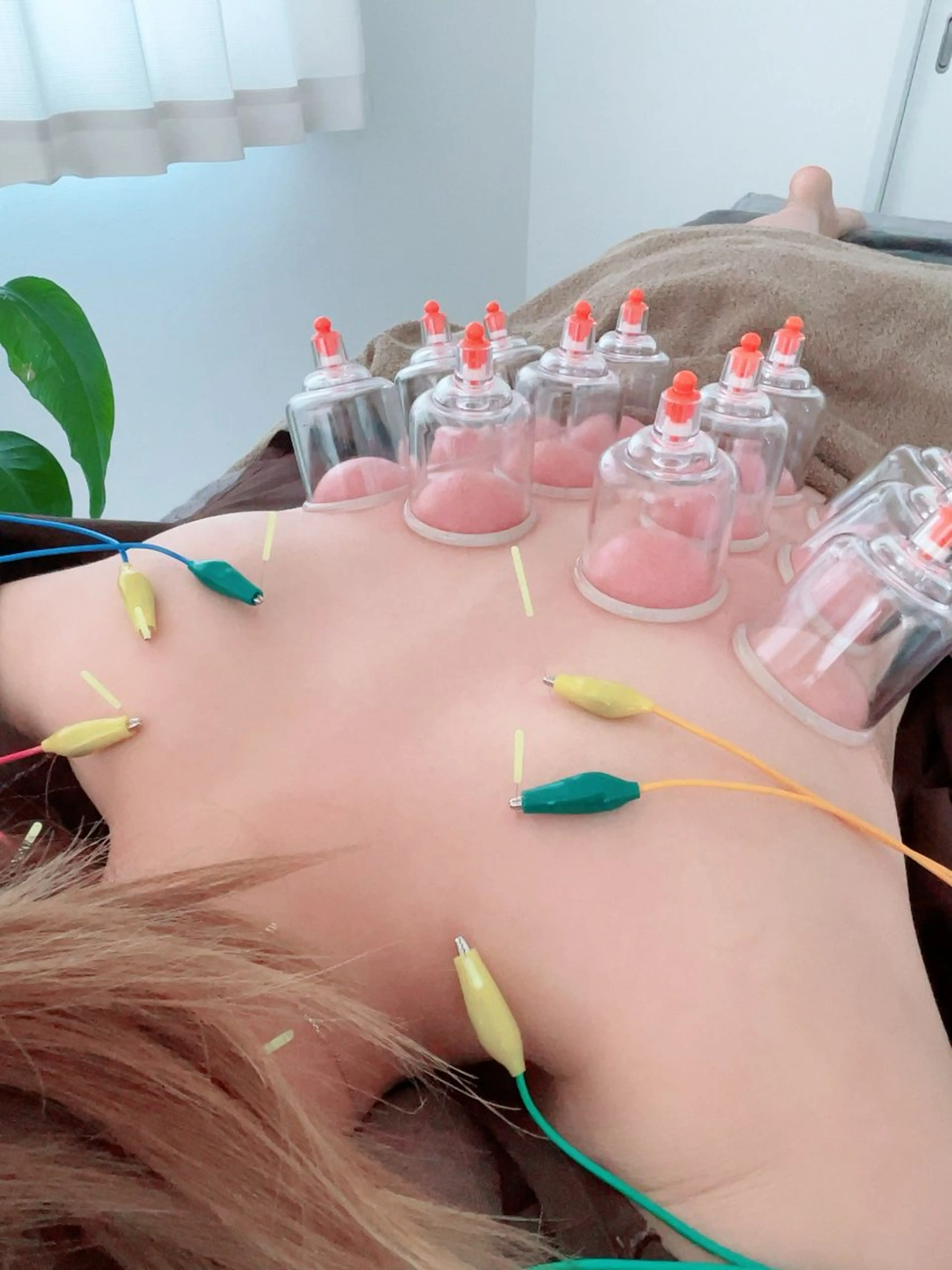 【☘️首肩こり集中ケア☘️】ボディ鍼灸×吸玉コース✨✨の写真