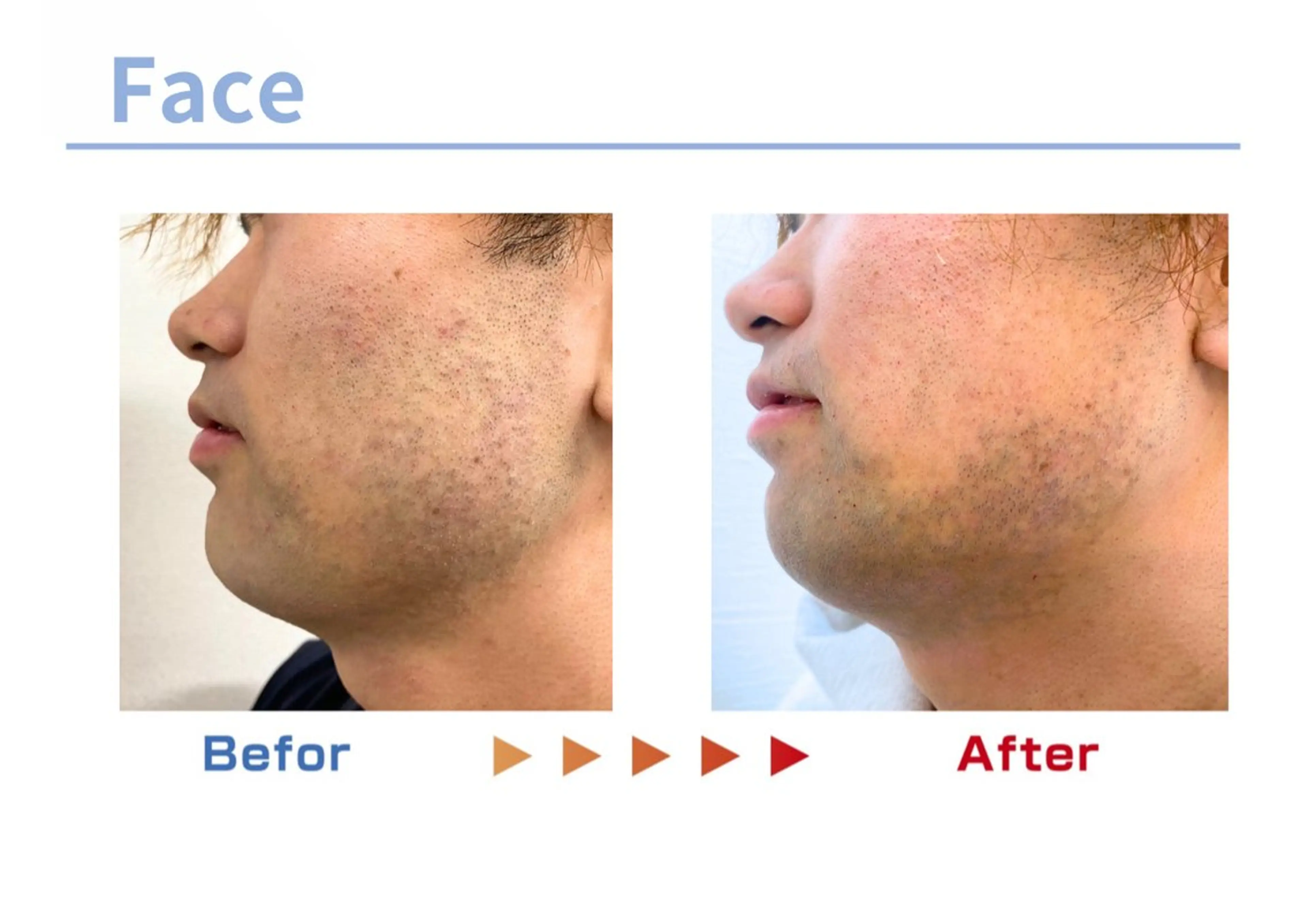 メンズ セルフ脱毛/美尻イス キングスサロン熊本のエステ・リラクイメージ