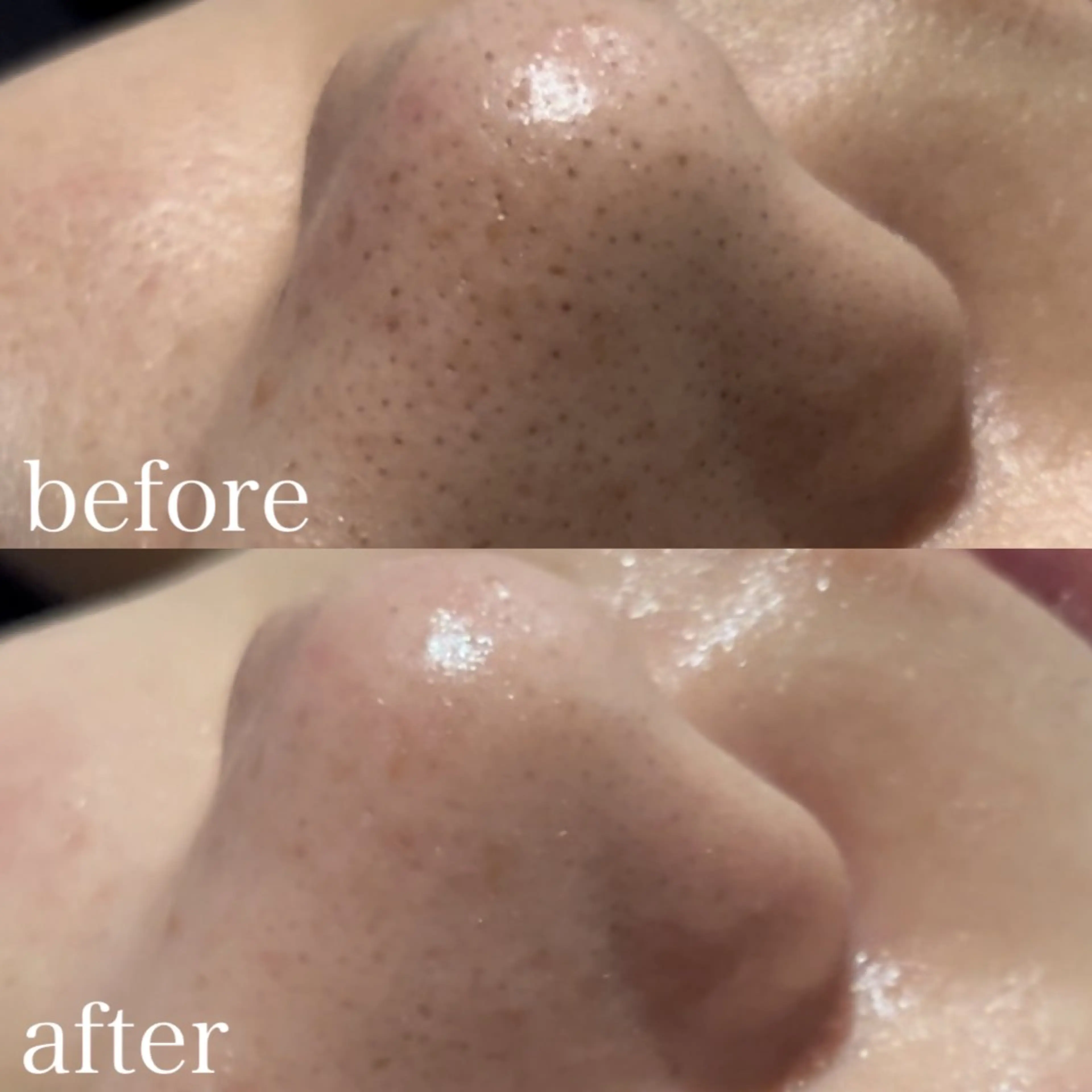 エステ REVIハーブピーリング/バストケア/脱毛 Retea.【ルテア】所属・ハーブピーリング| 毛穴洗浄|ルテアのエステ・リラクイメージ