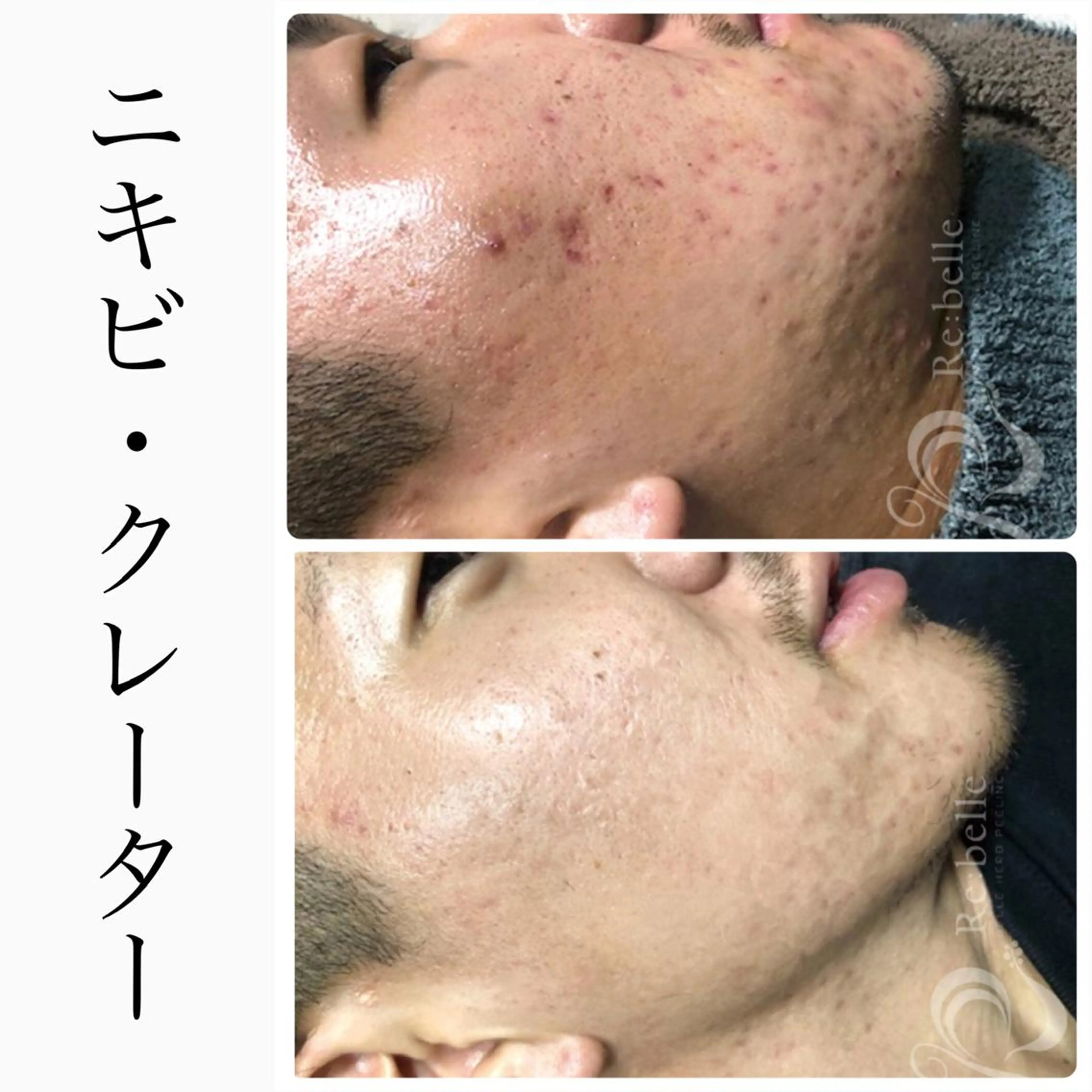 エステ BeSkin藤沢店所属・ニキビ/肌質改善 BeSkin 藤沢店のエステ・リラクイメージ