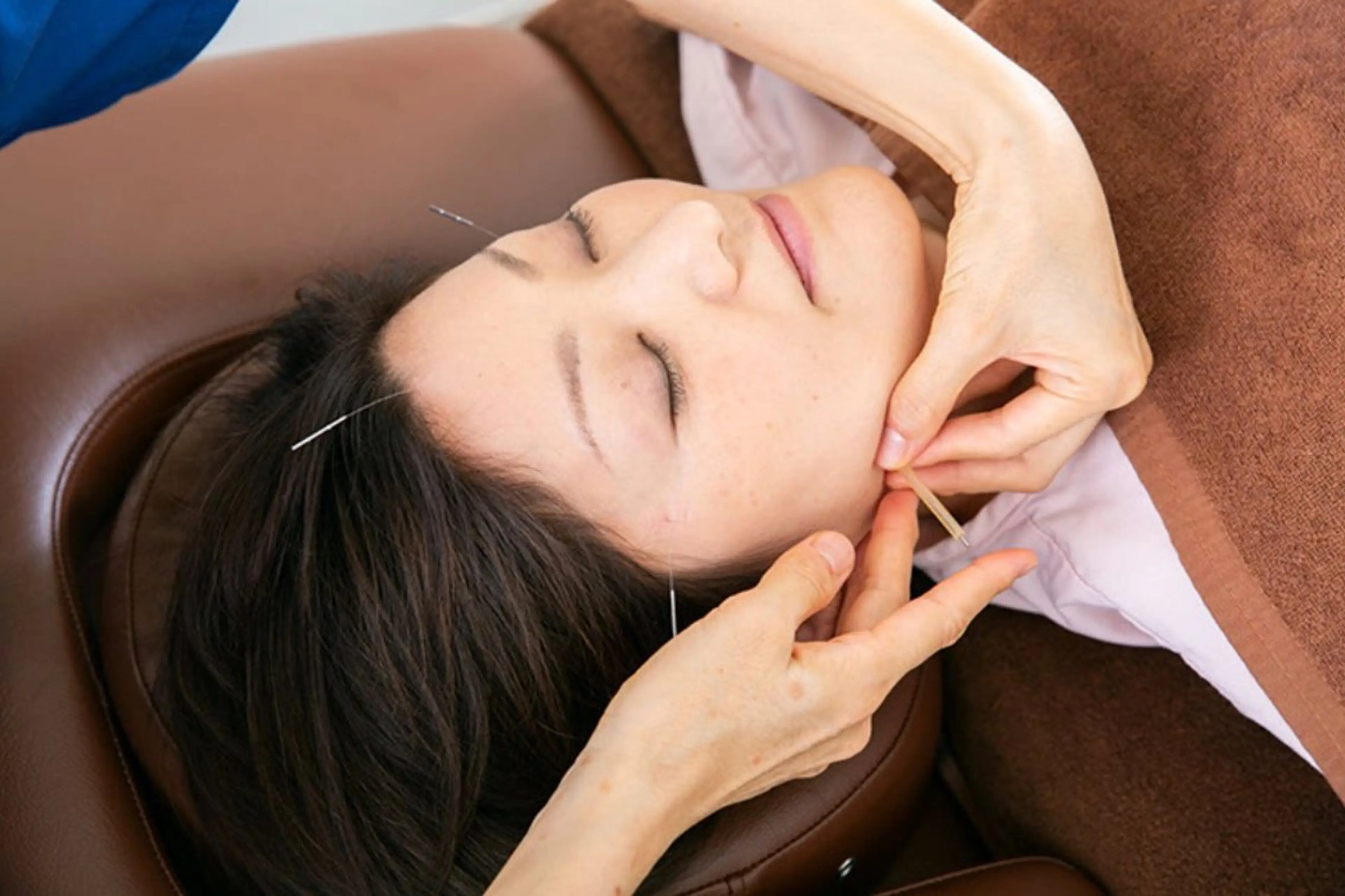 【内から輝く美しさの促進】美容鍼灸の写真