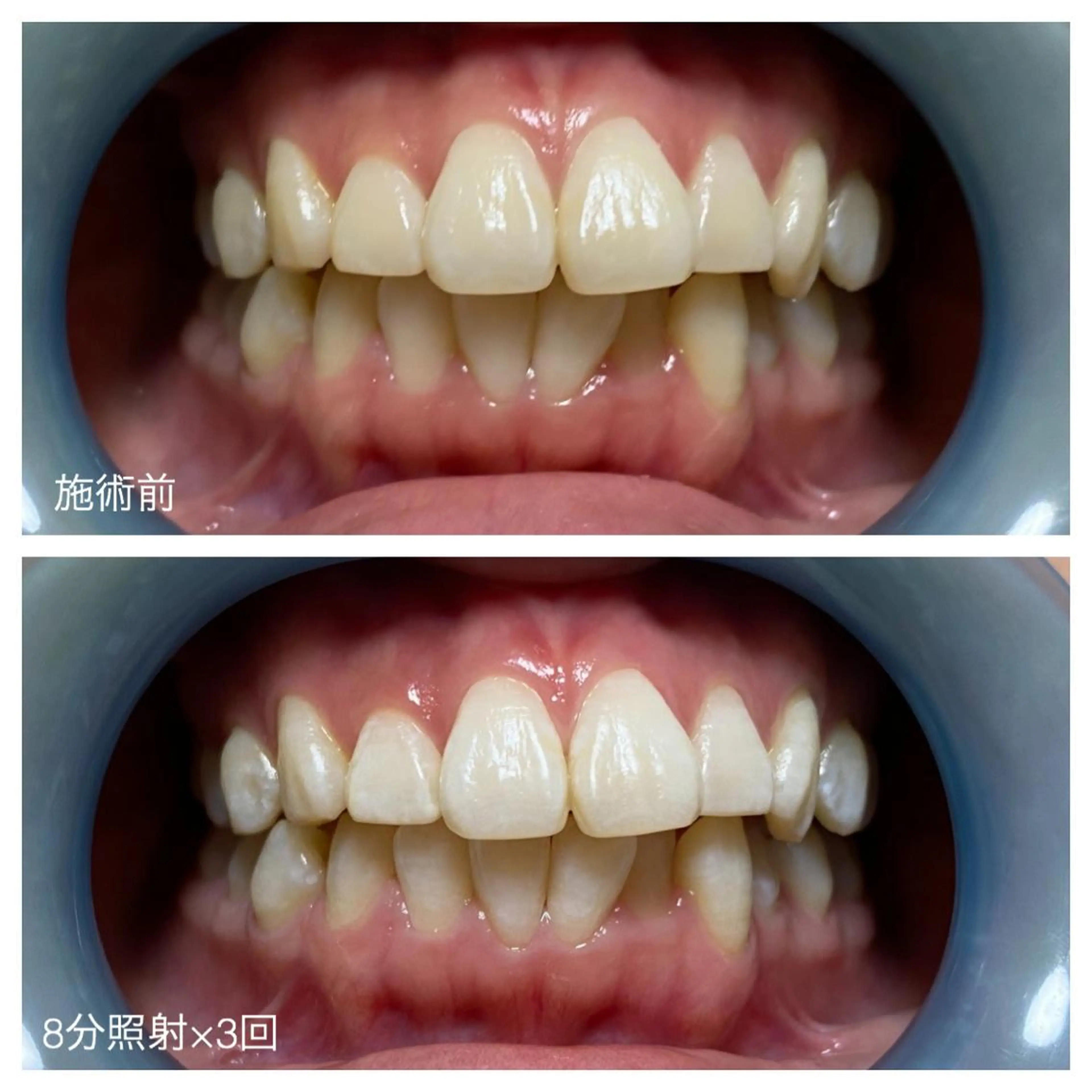 ネイル/耳つぼ /新ホワイトニングのネイルデザイン