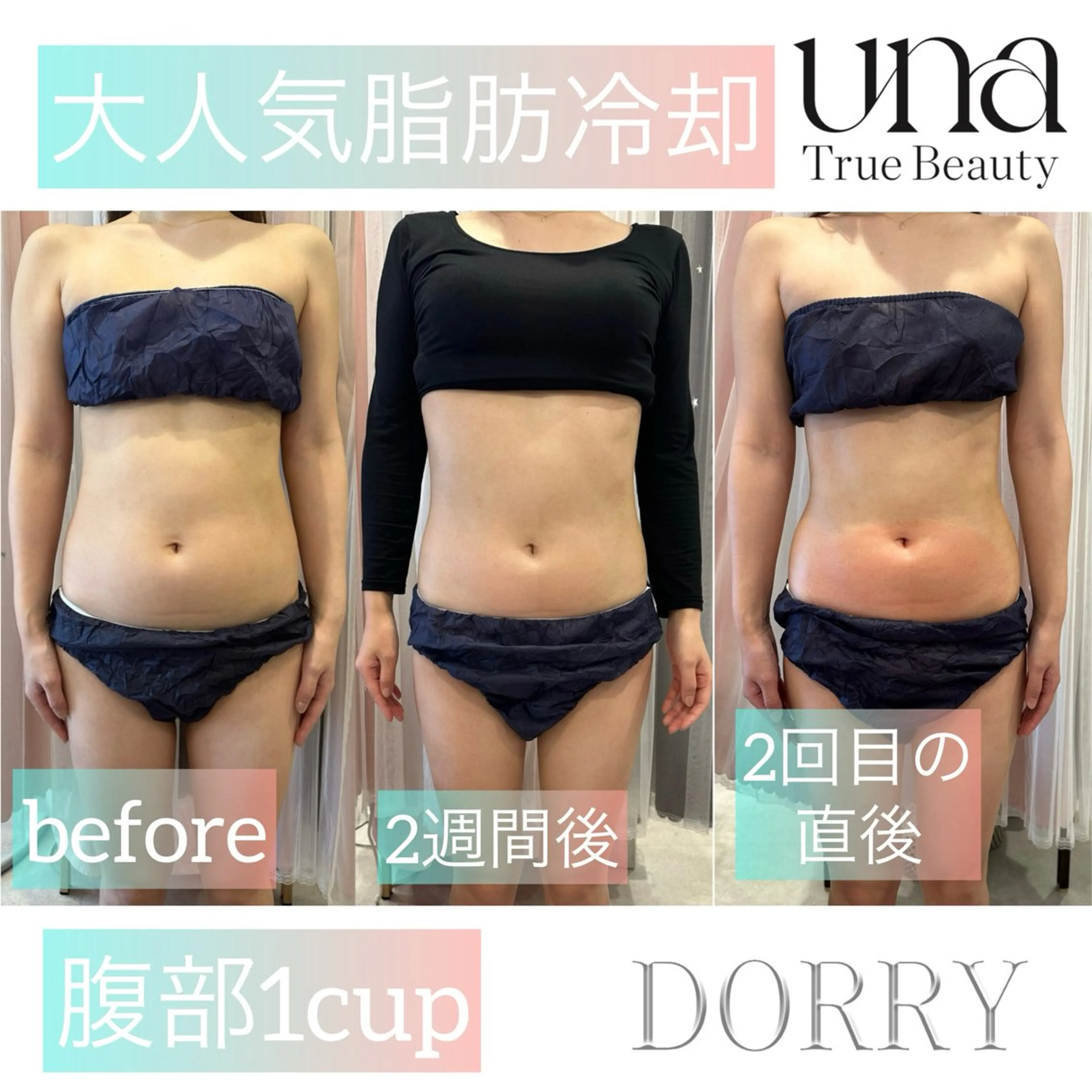 【初回限定】脂肪冷凍お腹Lカップ１つの写真