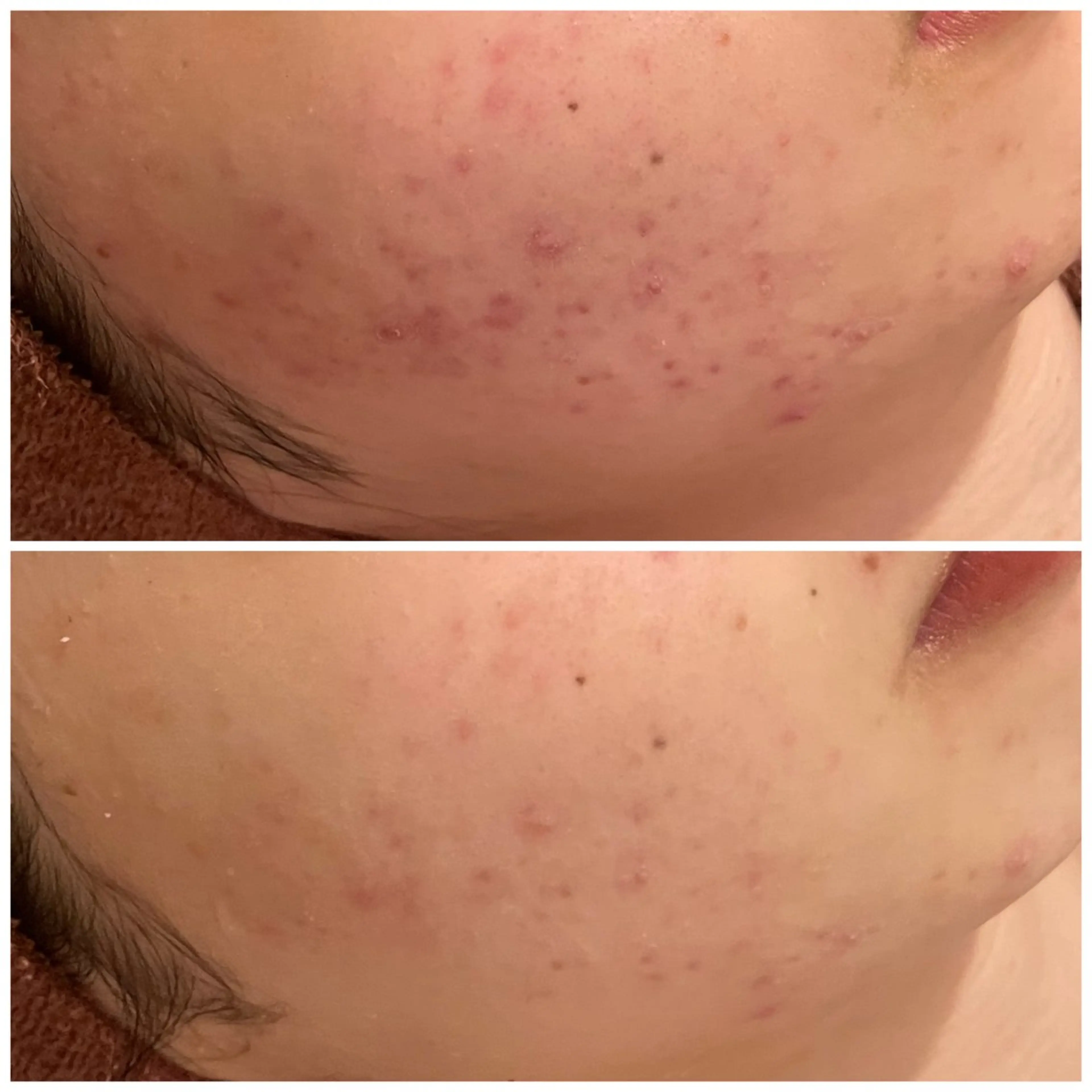 エステ リラク ニキビ特化型エステ 🍓最短で肌質改善のエステ・リラクイメージ