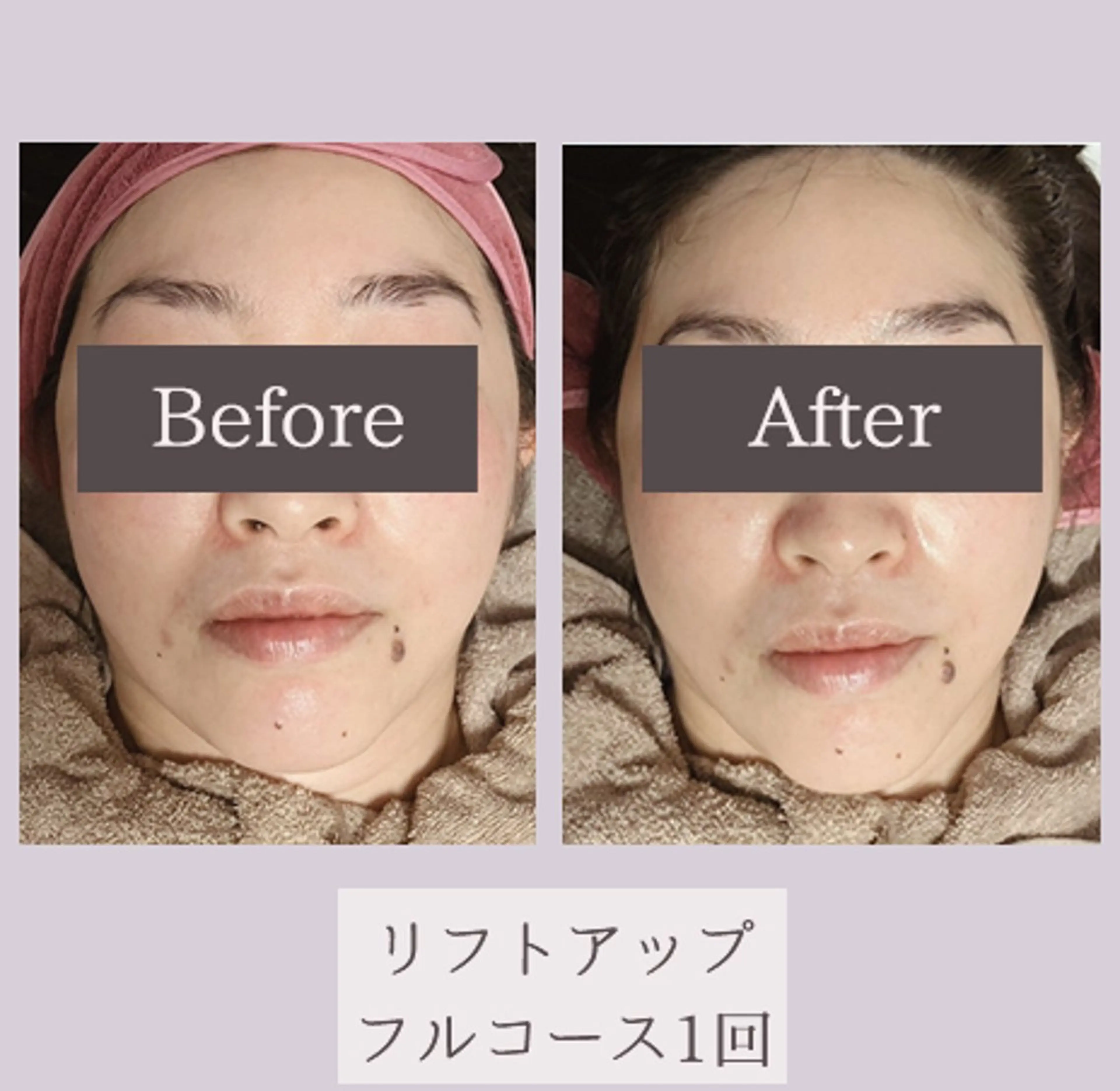 リフトアップフルコース❣️話題のサーマトリックスの効果をぜひお試し下さい🌟の写真