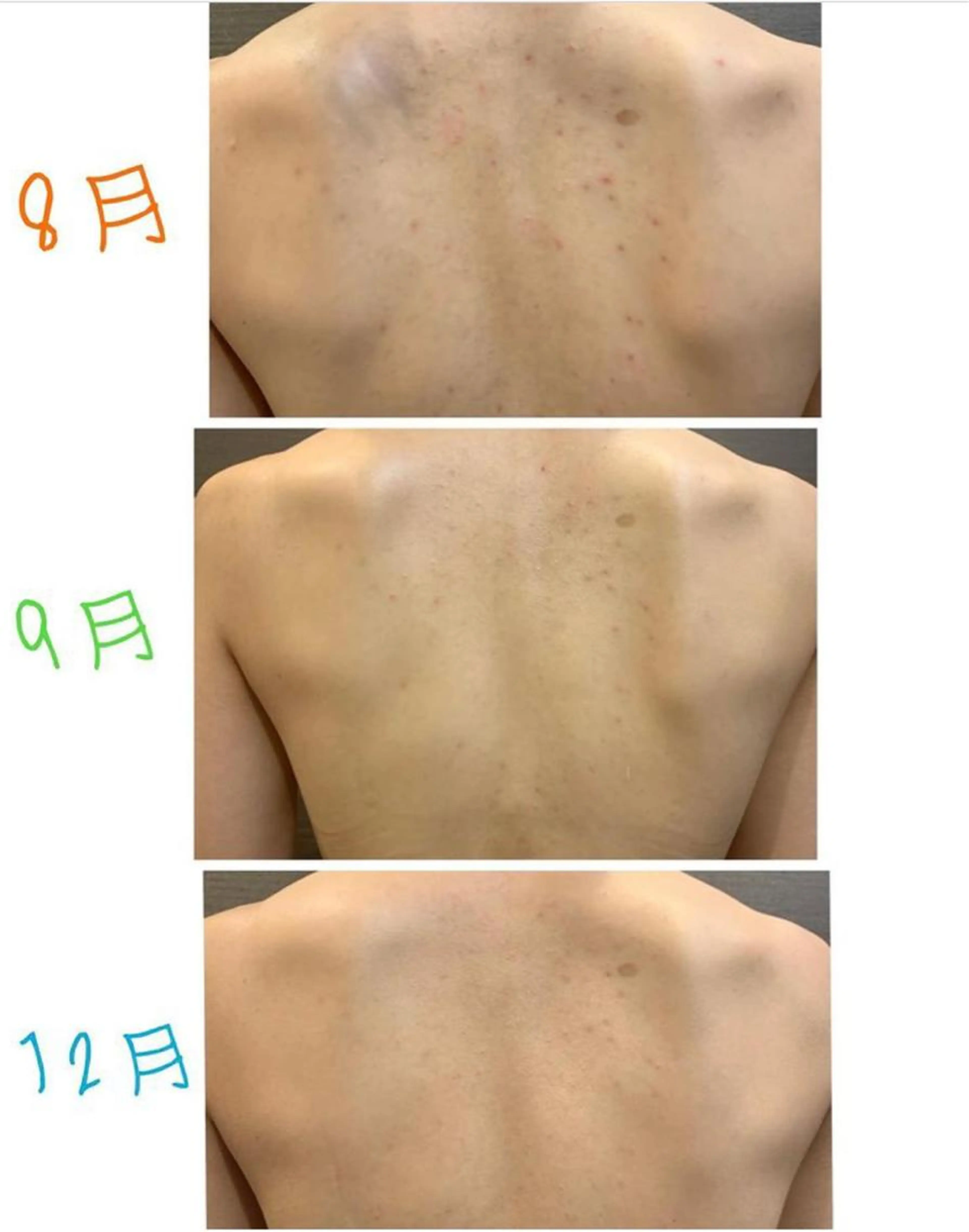 🎅１２月限定クーポン⭐️背中ニキビ、ニキビ跡ケア✨の写真