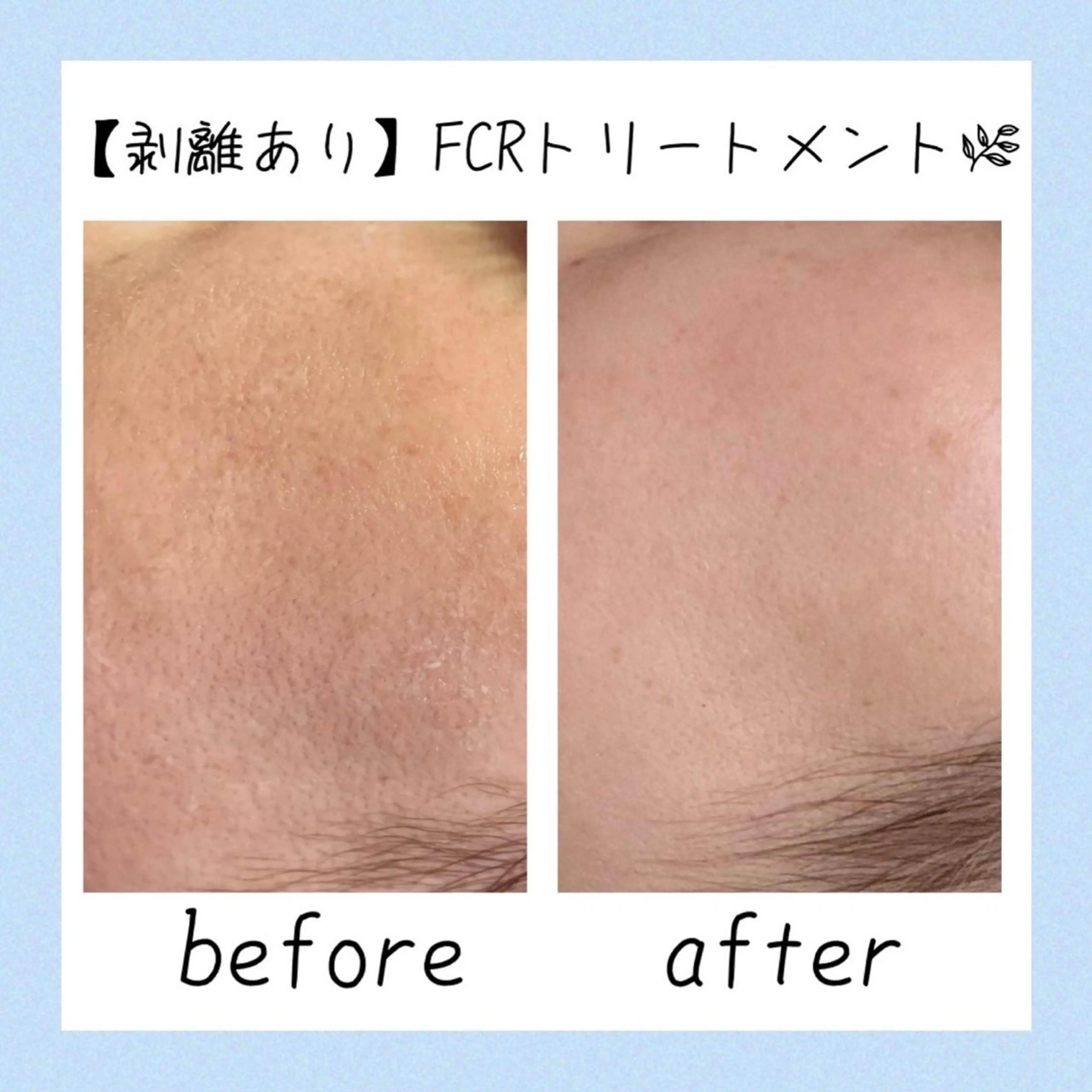 ニキビ改善シャルム ココハーブピーリングのエステ・リラクイメージ