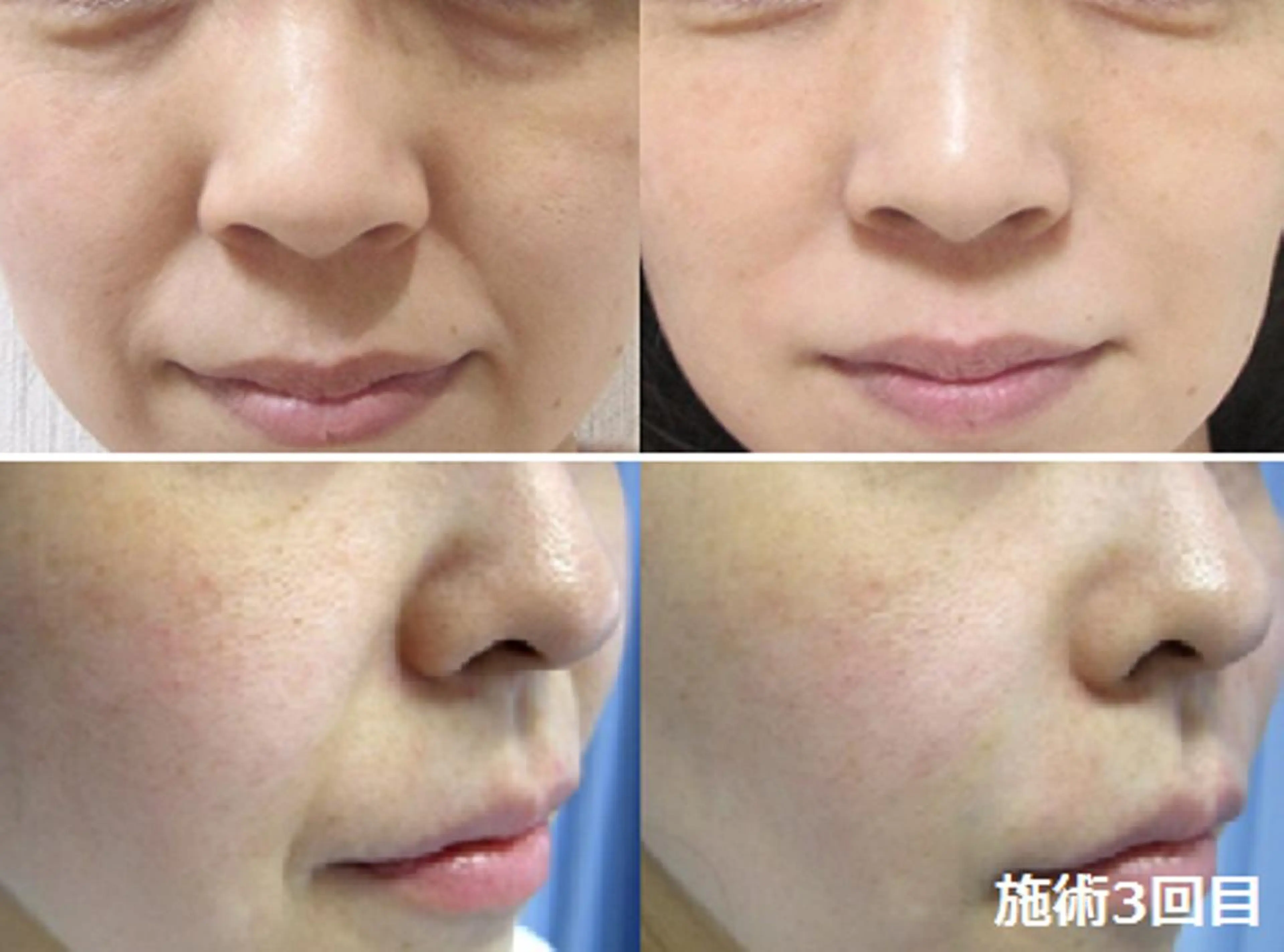 顔脱毛＆毛穴＆ニキビ 優良№1♪ヒロコ♪のエステ・リラクイメージ