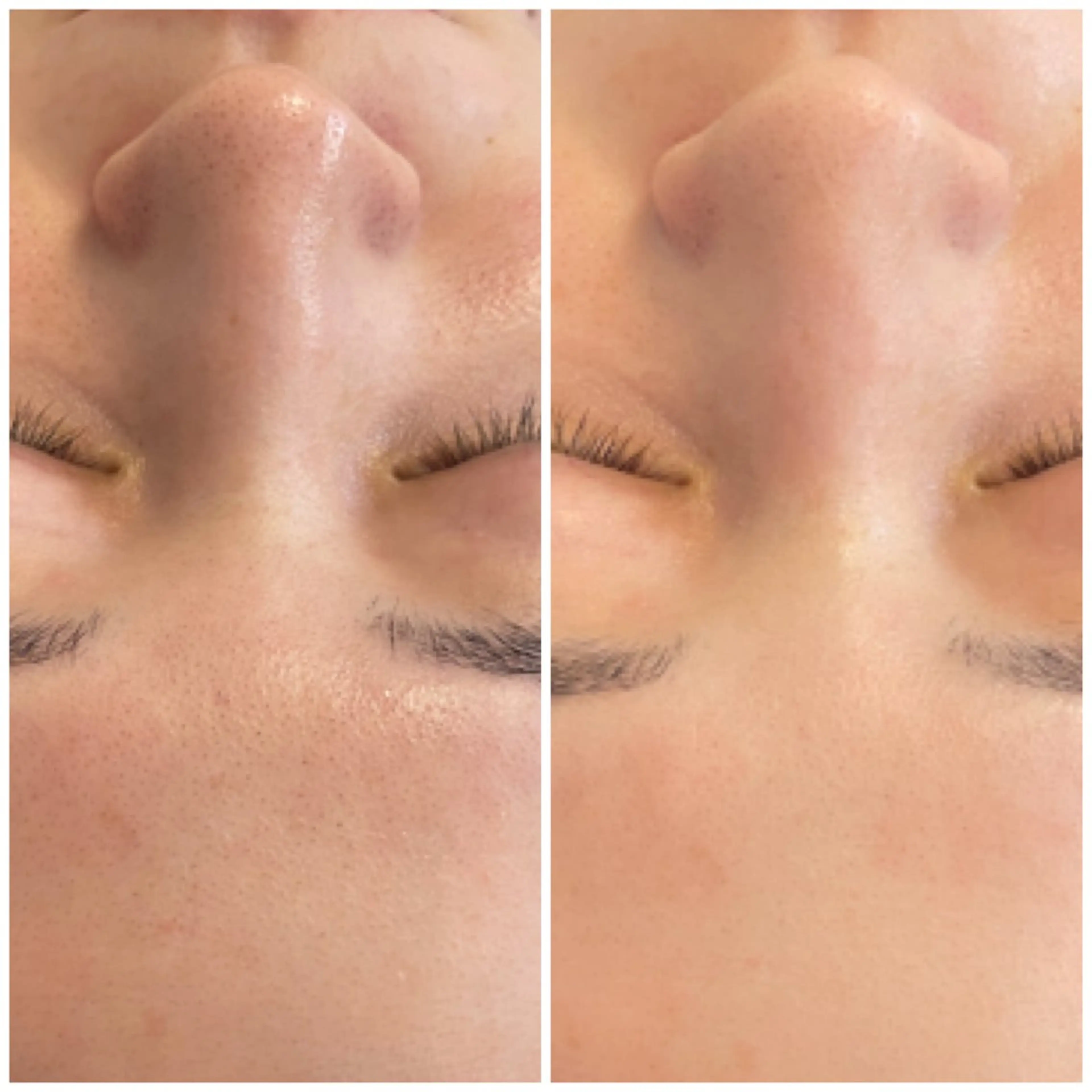 毛穴黒ずみ×くすみにサヨナラ👋 パッと明るくフィルター素肌🫧【次世代🫶毛穴ケア✖️美白ケア】60分の写真