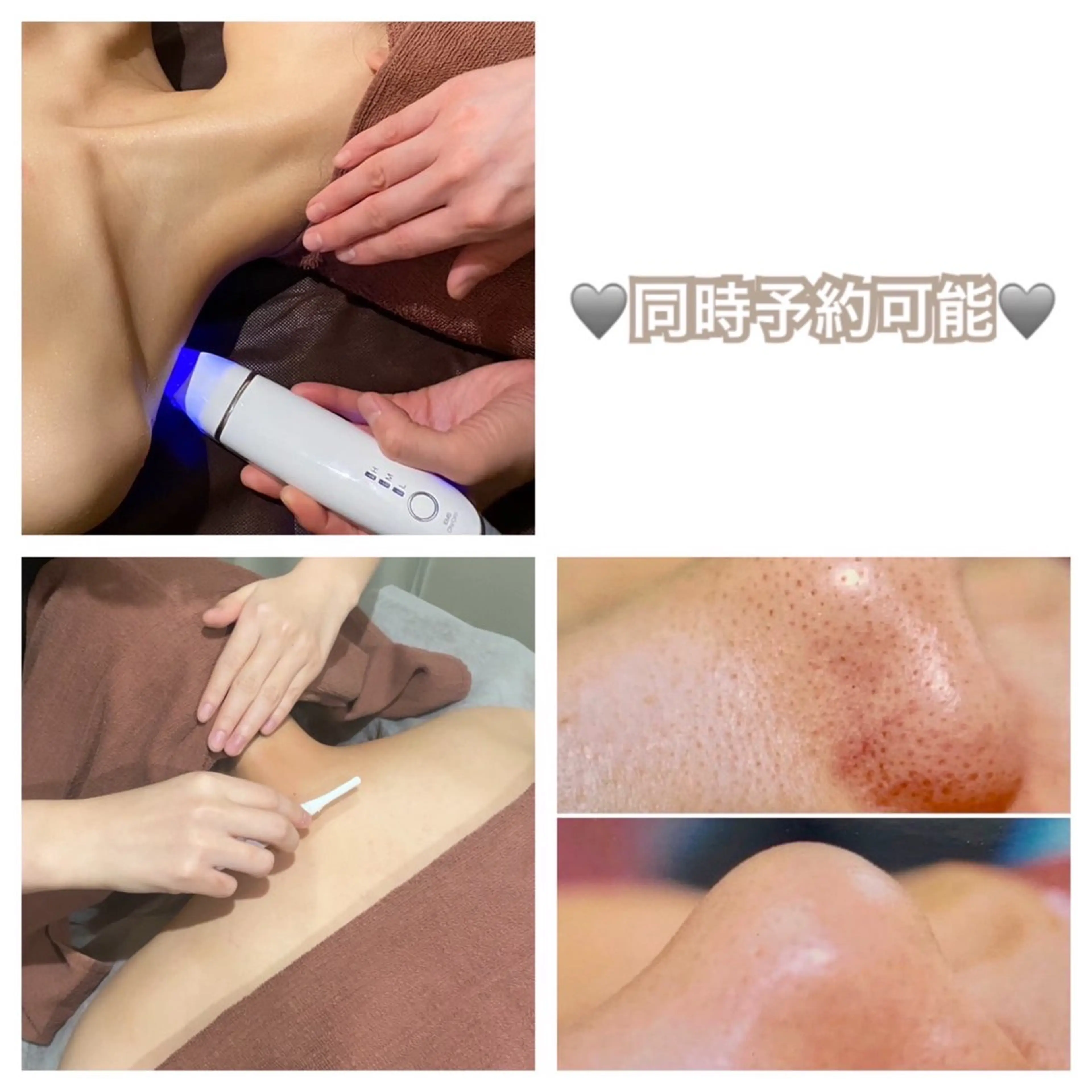 人気メニューです☺️頬全体脱毛🌟人気の韓国エアバリ🌟毛穴吸引3つのメニューを一緒に施術できます😃の写真