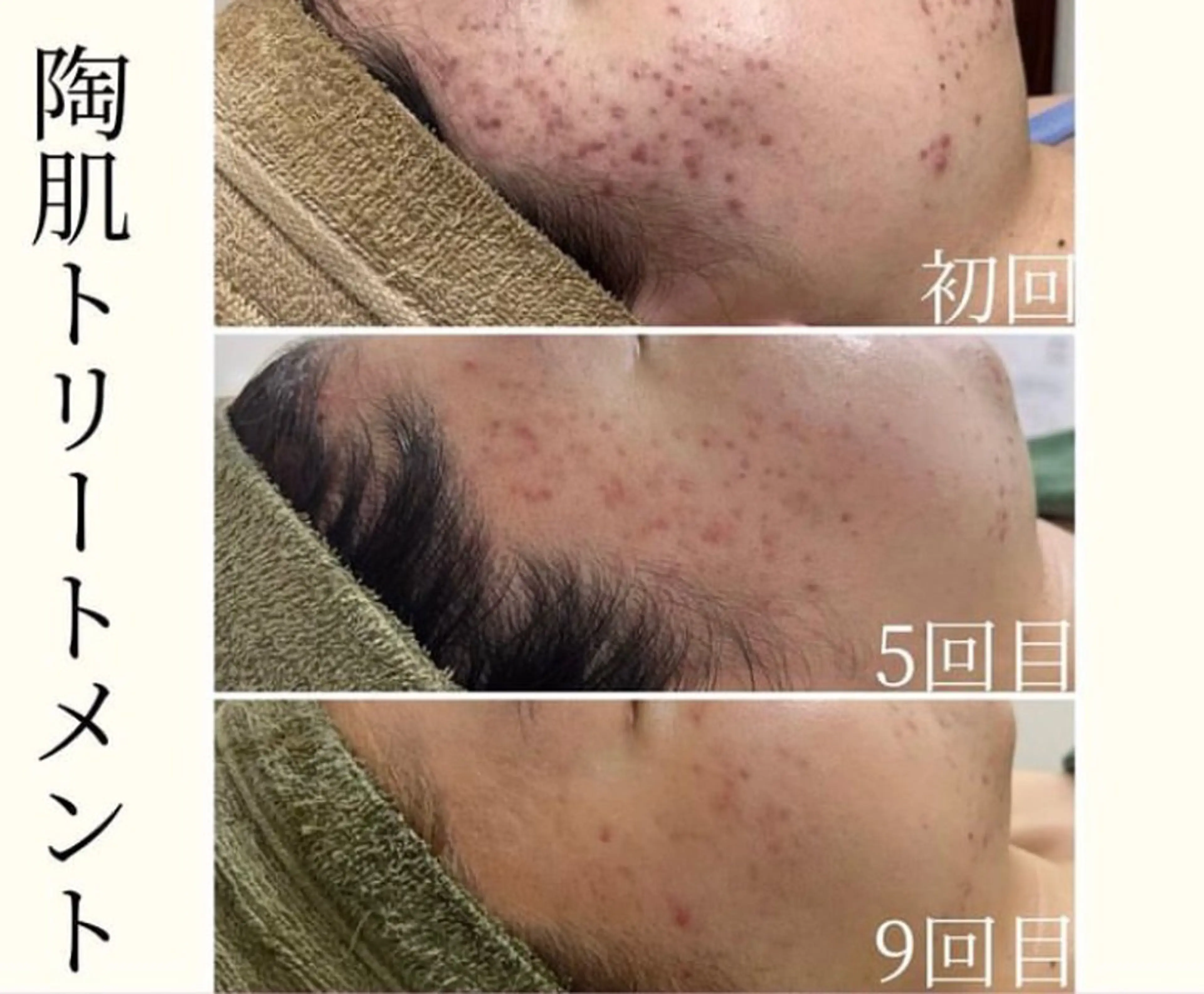 【ニキビ・ニキビ跡に特化！】REVIハーブピーリング2g🌿/1オプション付✨の写真