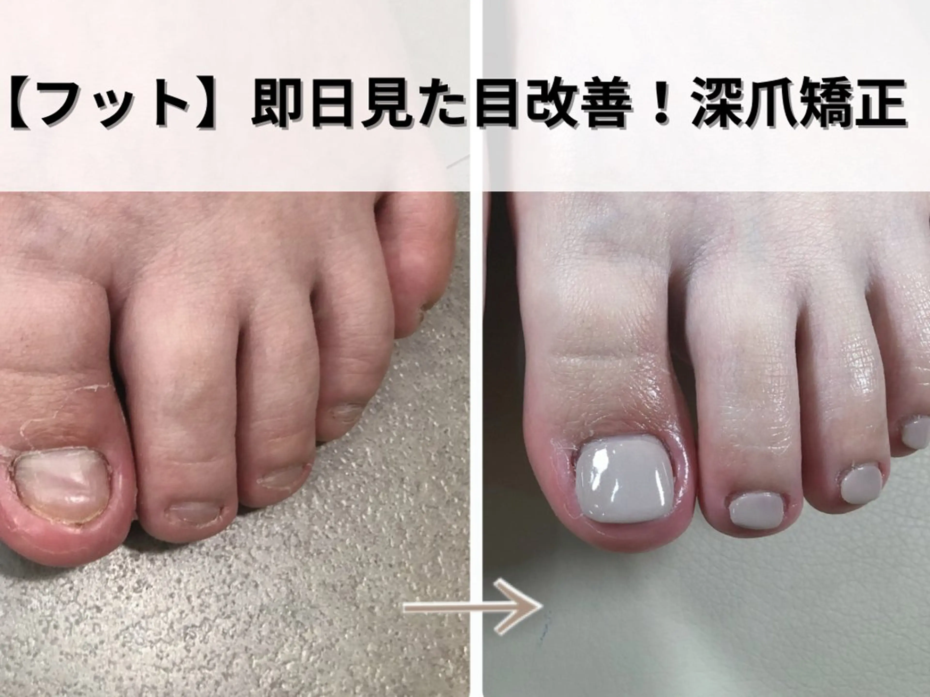 ネイル 深爪矯正専門ネイルサロンエルナ所属・深爪矯正専門 ネイルサロンエルナのネイルデザイン