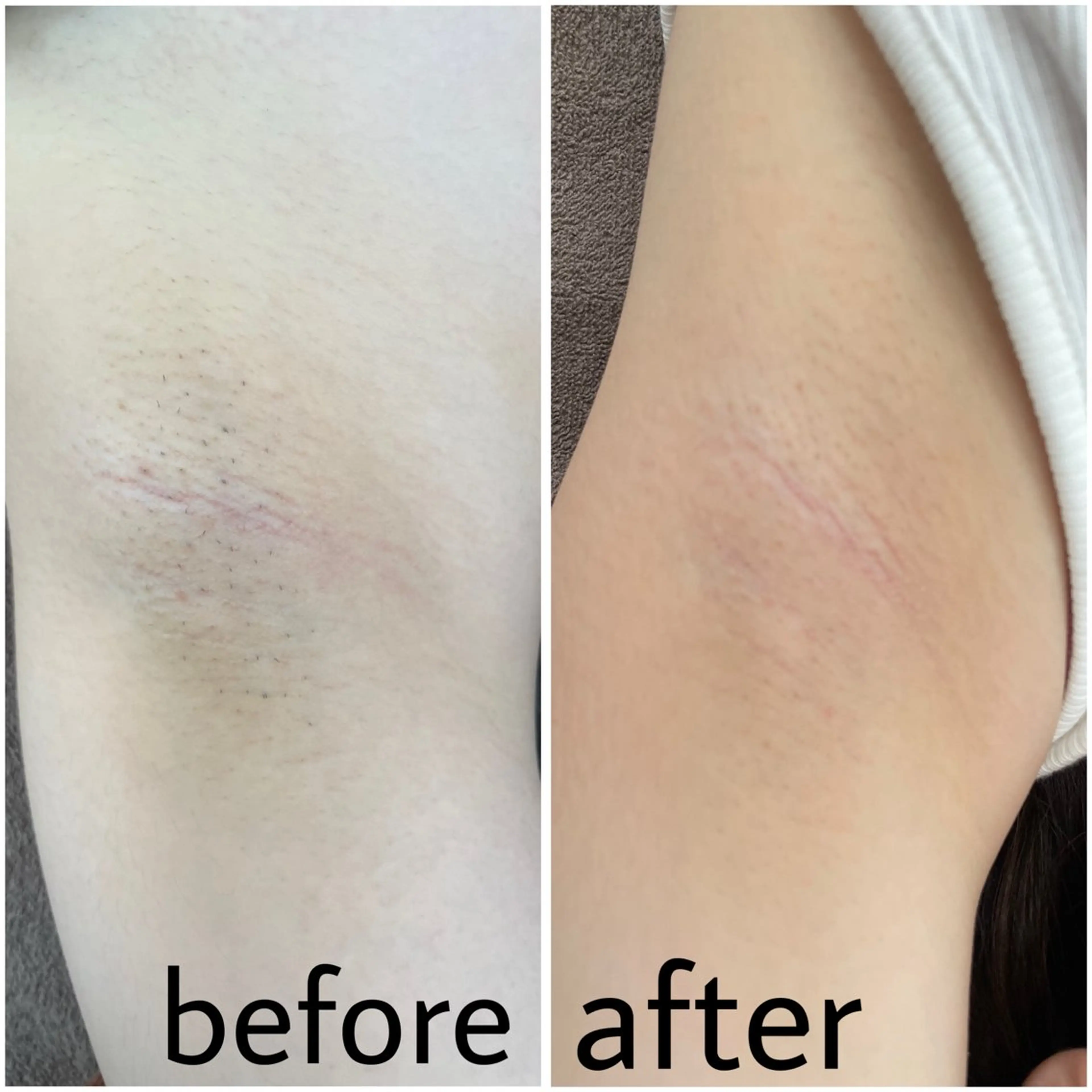 12月22日限定🉐ワンコイン両脇脱毛♡の写真