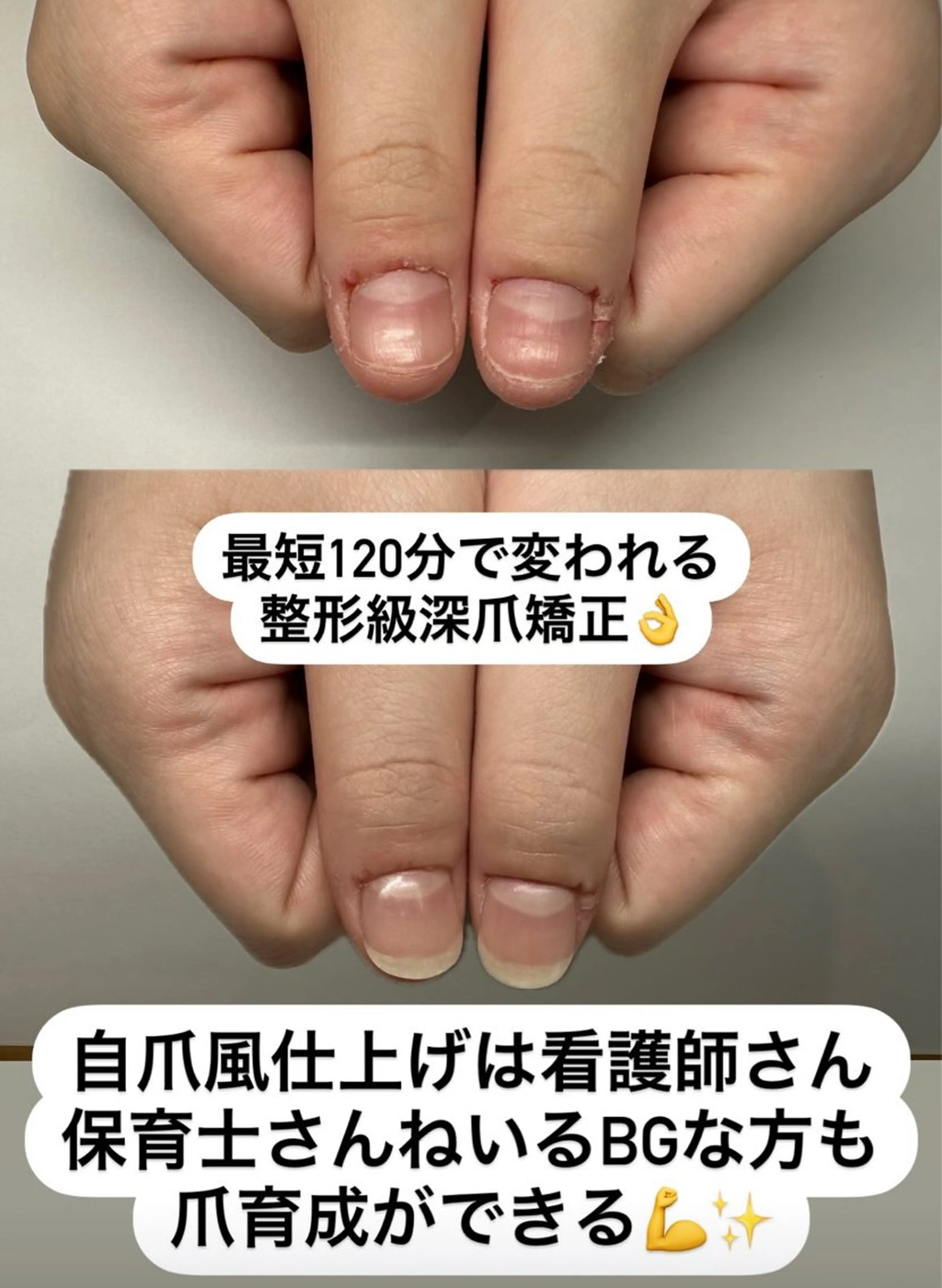 【新規様限定】ハンド深爪矯正/周りにバレずに深爪矯正〜まるで自爪が伸びたような自然な仕上がりで長さ出しの写真