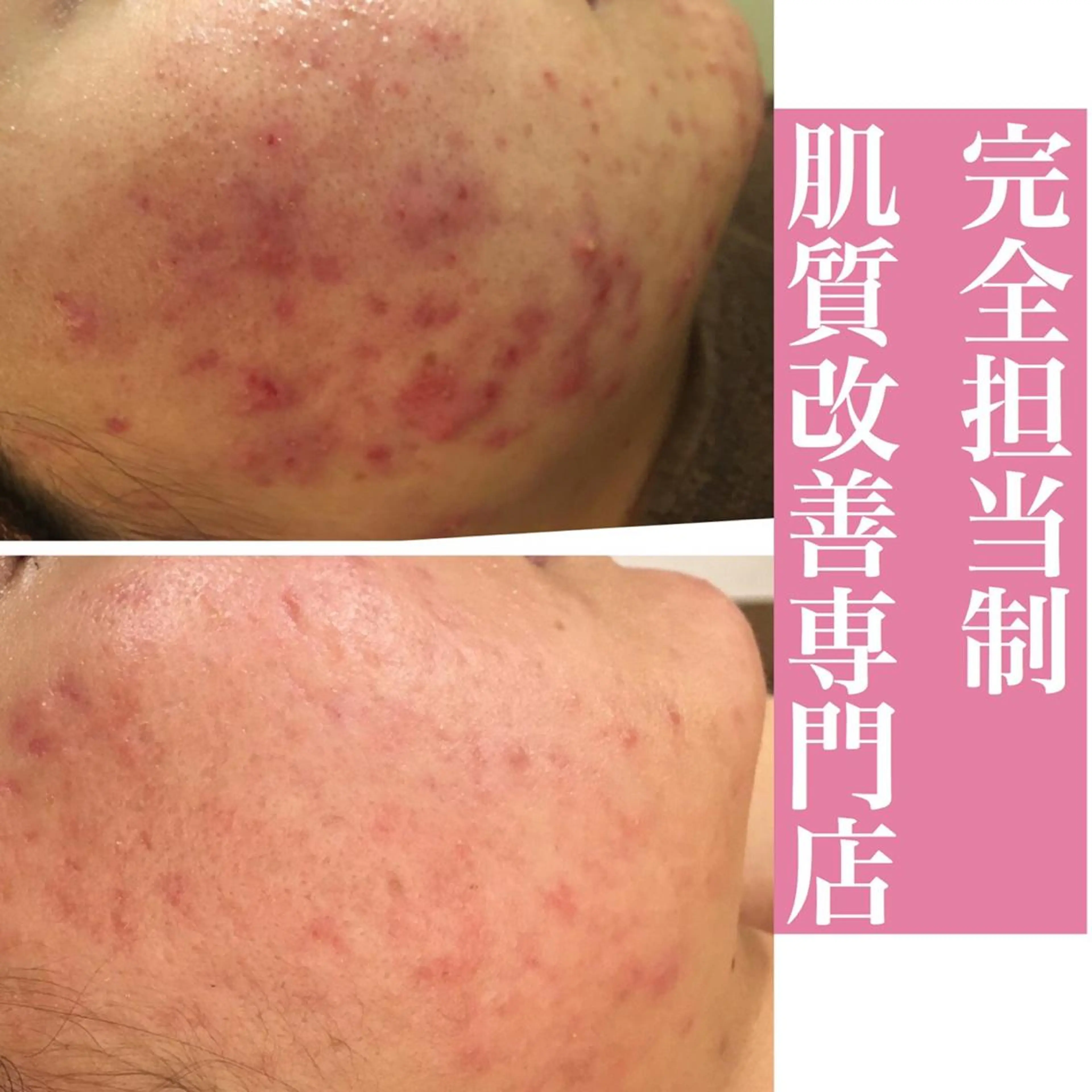 ミディアム カラー パーマ ヘアアレンジ メンズ キッズ ネイル マツエク・マツパ アイブロウ エステ リラク ニキビ・肌質改善専門 ♡人生が変わるサロンのエステ・リラクイメージ