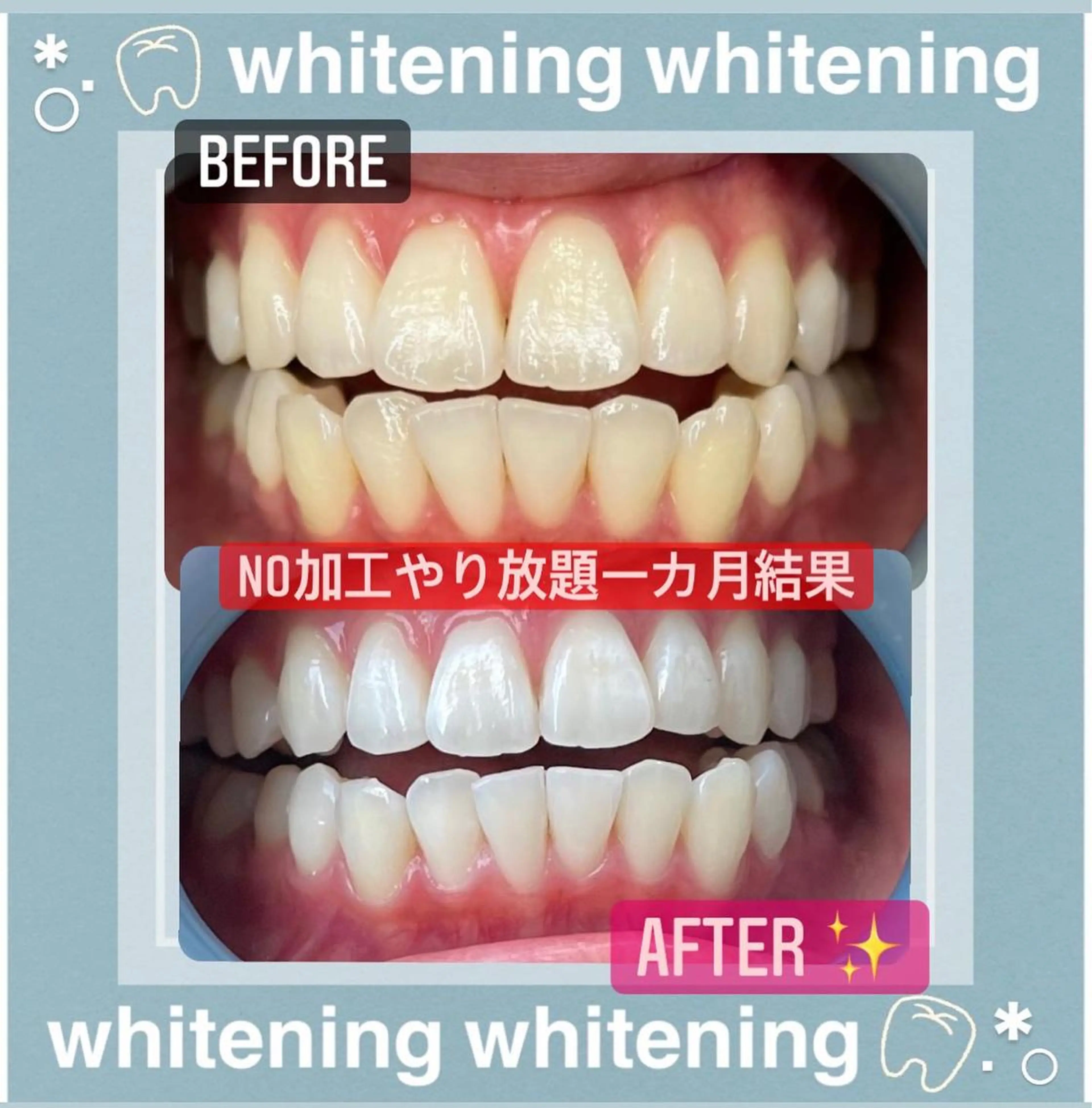 【歯本来の白さmaxまで一気に制限なく目指したい方、ミニモ限定】ホワイトニングやり放題一ヶ月【すぐ予約対象外】の写真